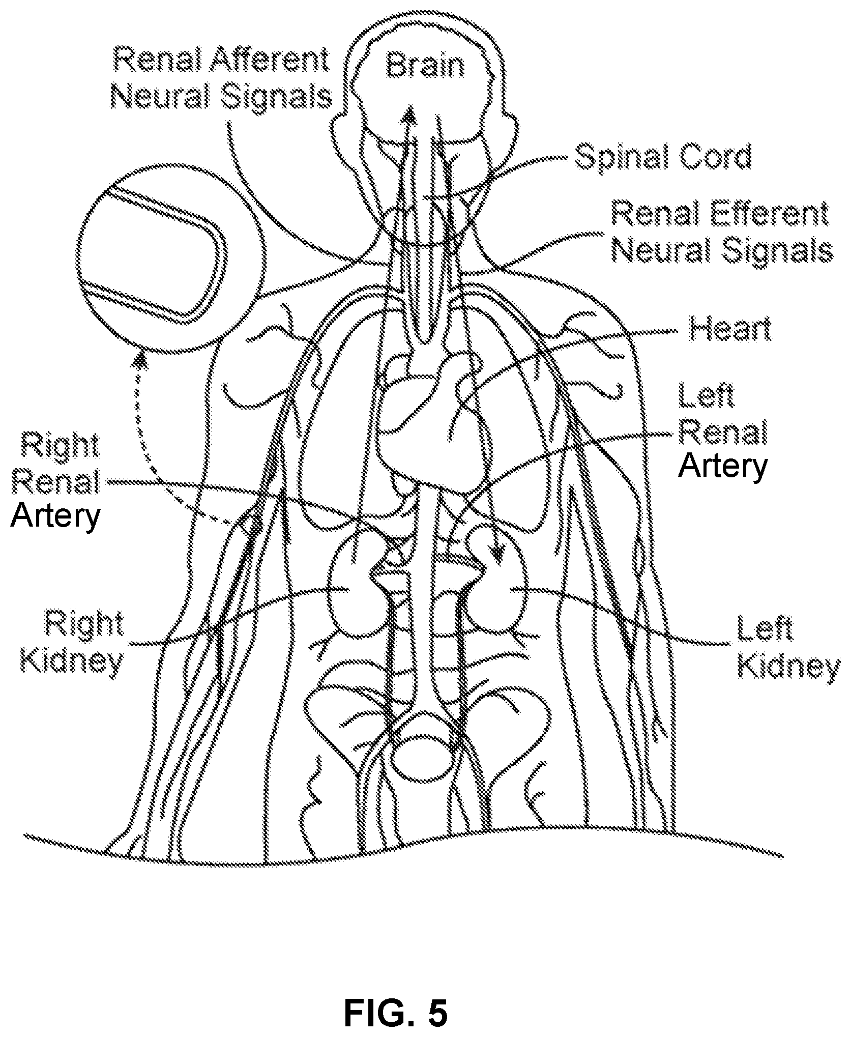 Patent US12551282 Figure 5 – Percutaneous medical device navigation system