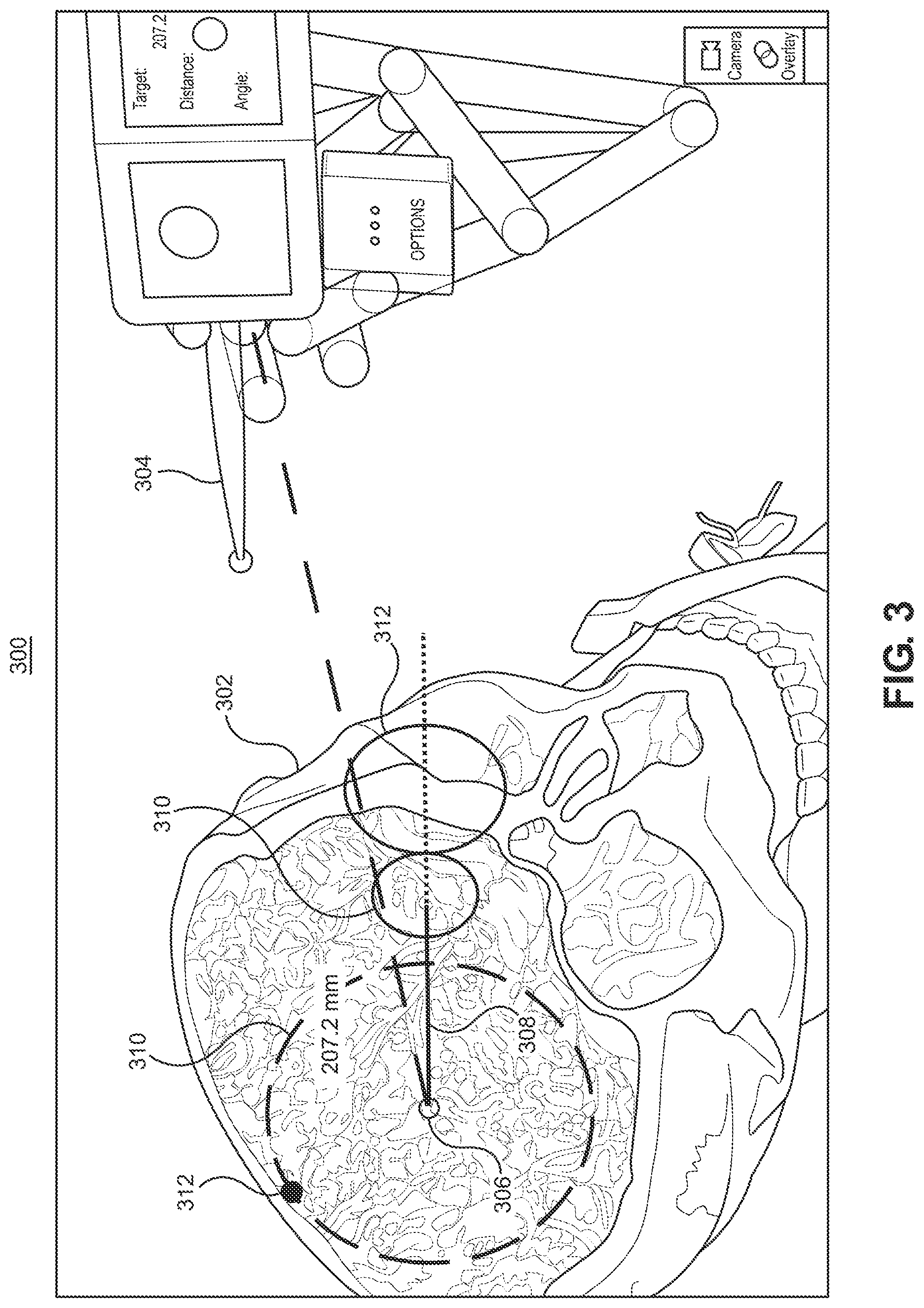Patent US12551283 Figure 4 – Surgical navigation trajectory in augmented reality display