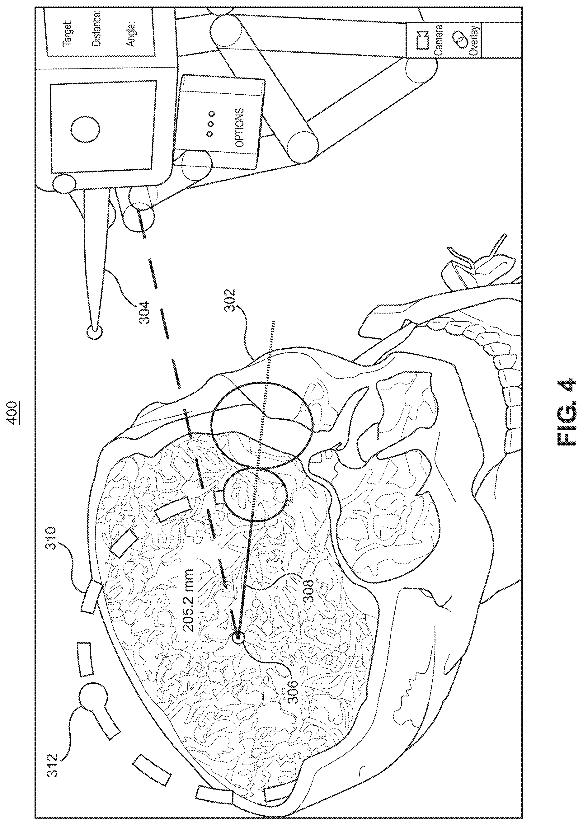 Patent US12551283 Figure 5 – Surgical navigation trajectory in augmented reality display