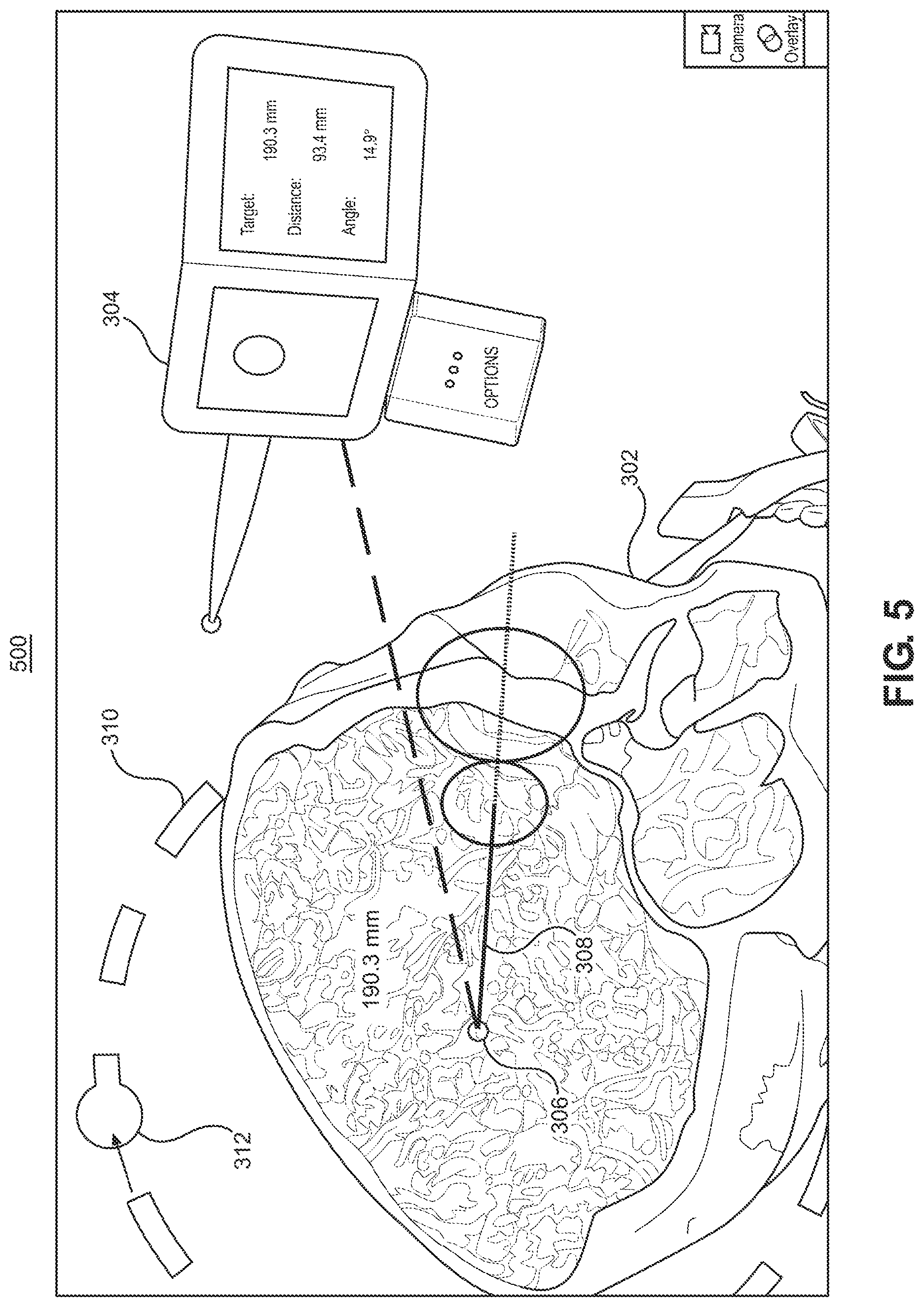Patent US12551283 Figure 6 – Surgical navigation trajectory in augmented reality display