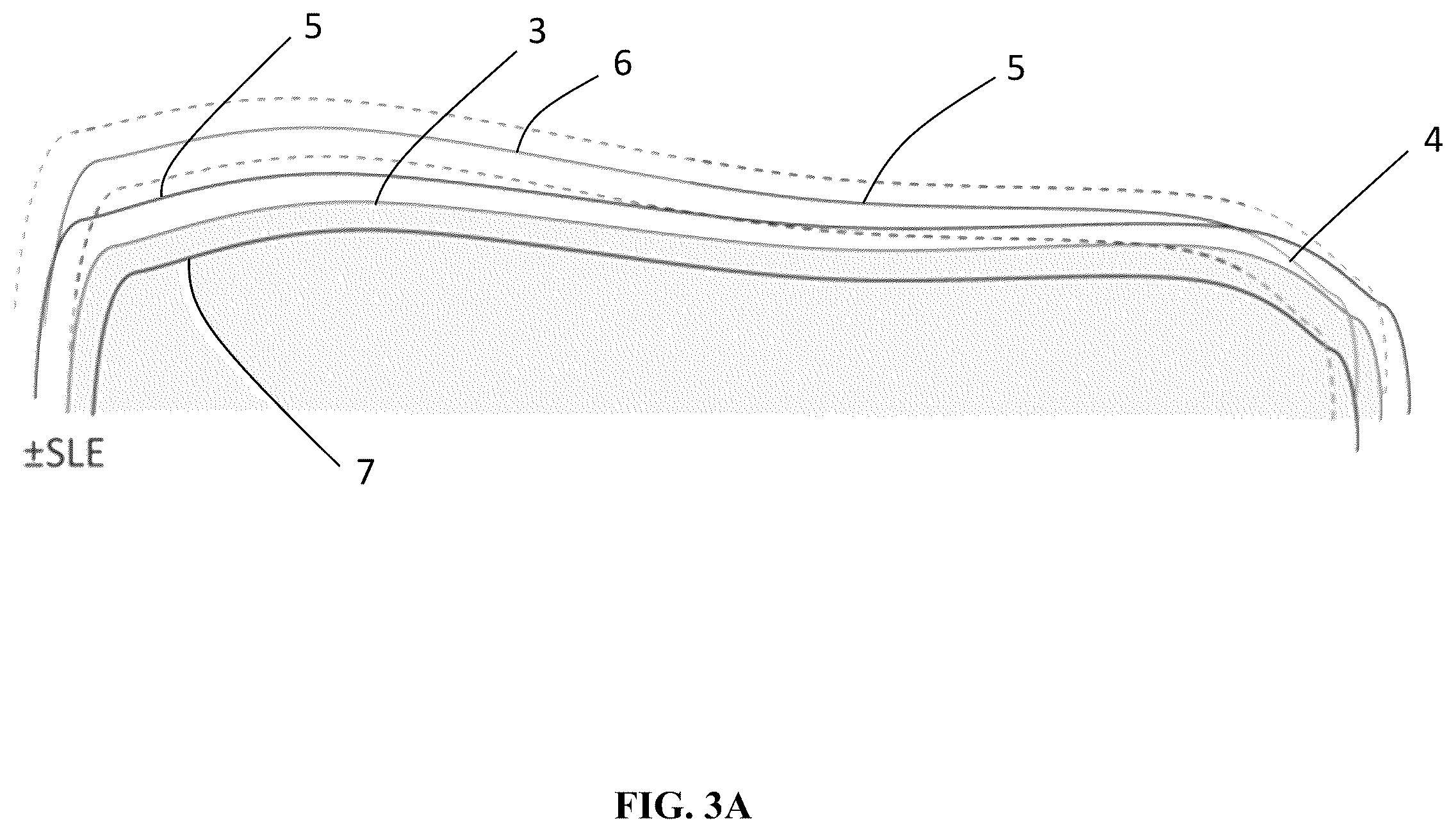 Patent US12551284 Figure 3 – Implant design optimization for geometric uncertainty