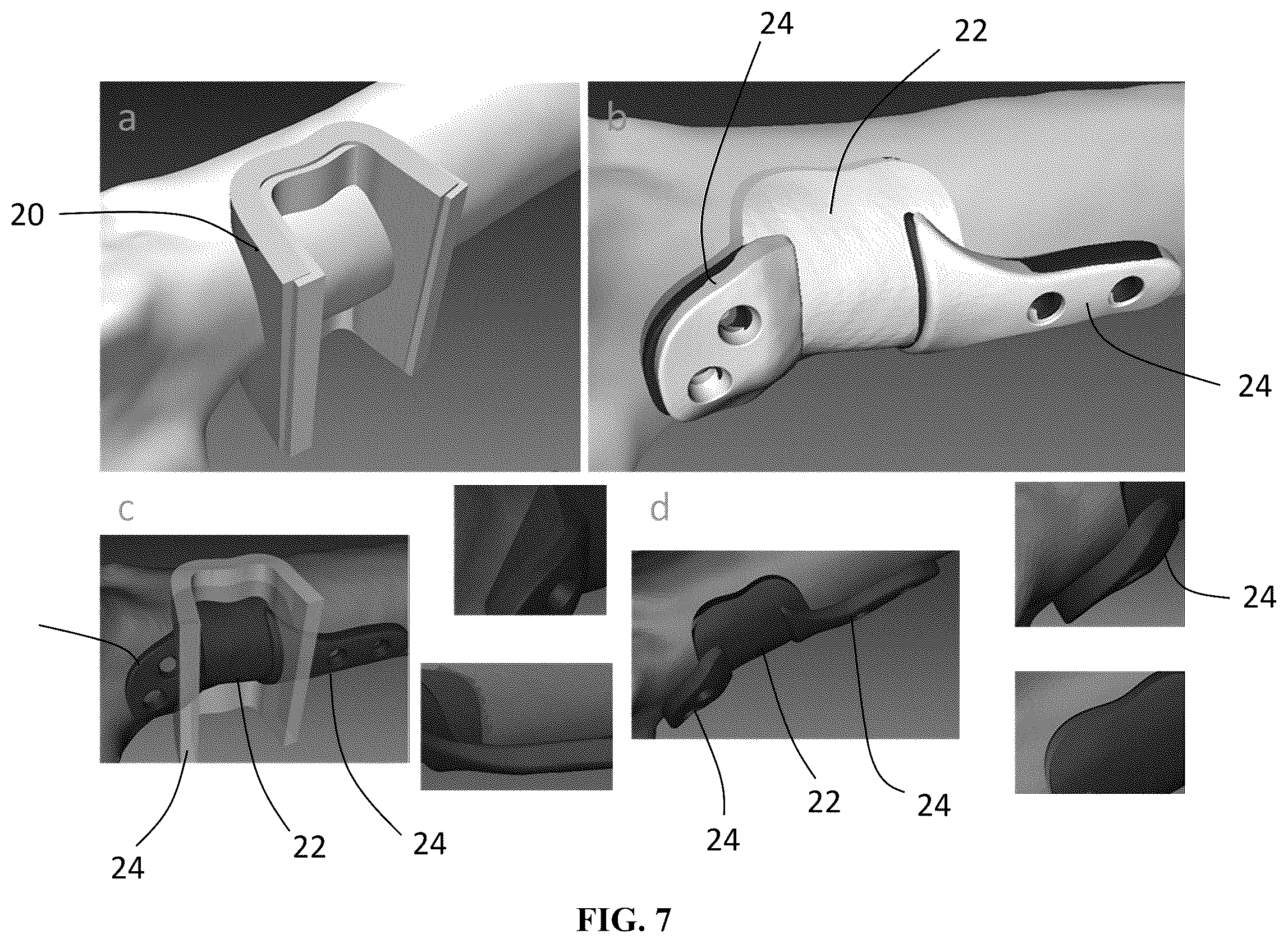 Patent US12551284 Figure 10 – Implant design optimization for geometric uncertainty