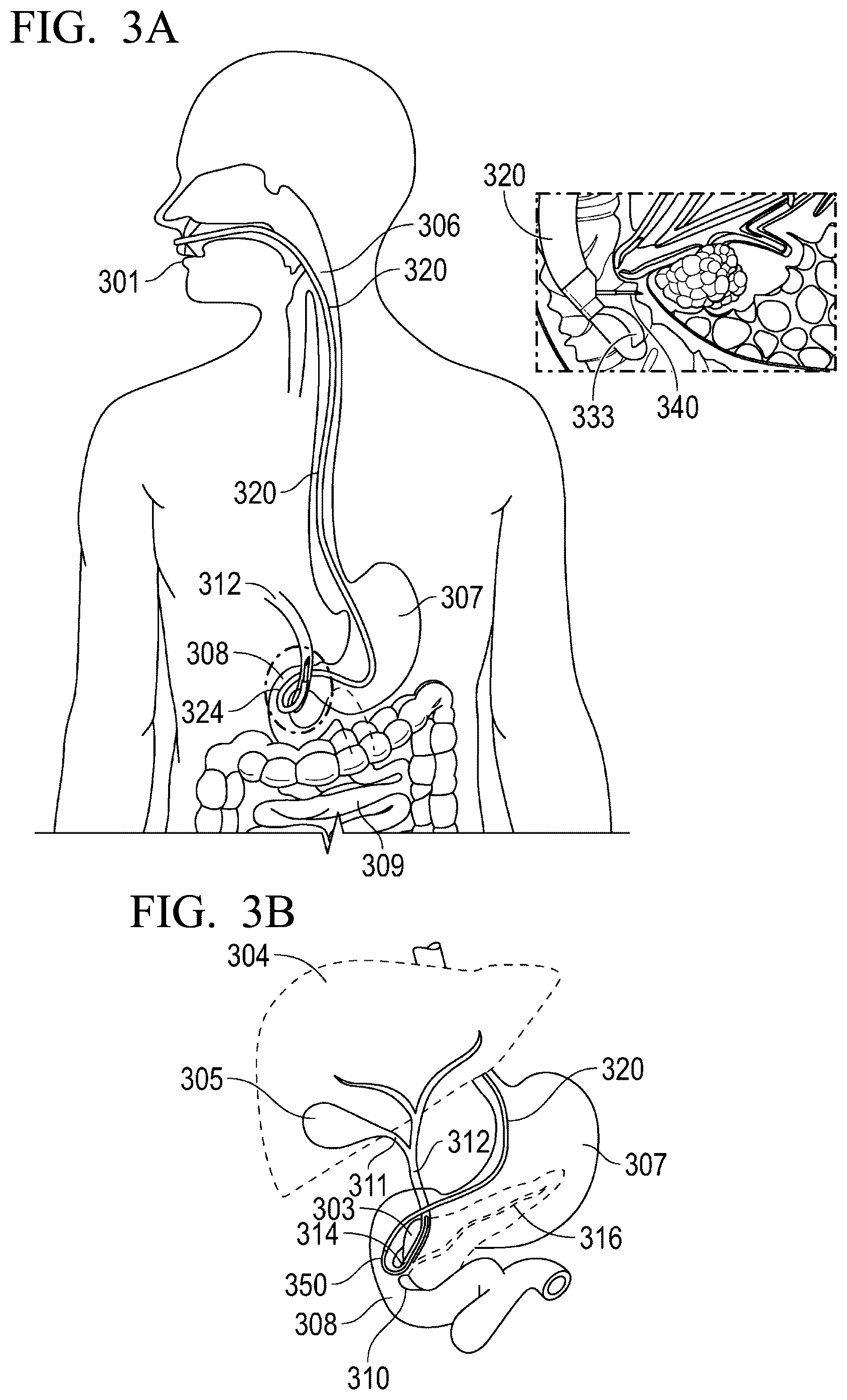 Patent US12551285 Figure 3 – Endoscopic ultrasound guided tissue acquisition