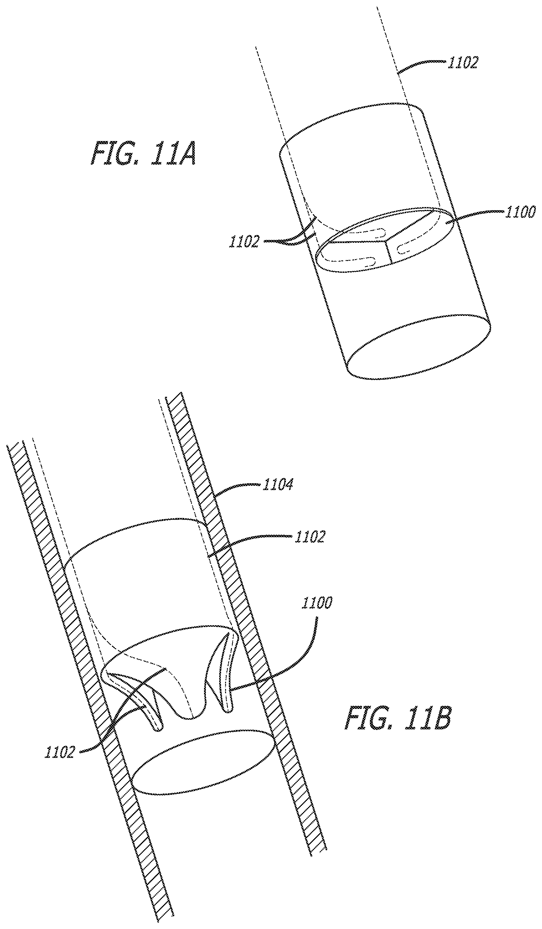 Patent US12551288 Figure 14 – Fiber optic enabled deployable medical devices for monitoring, assessment and capture of deployment information
