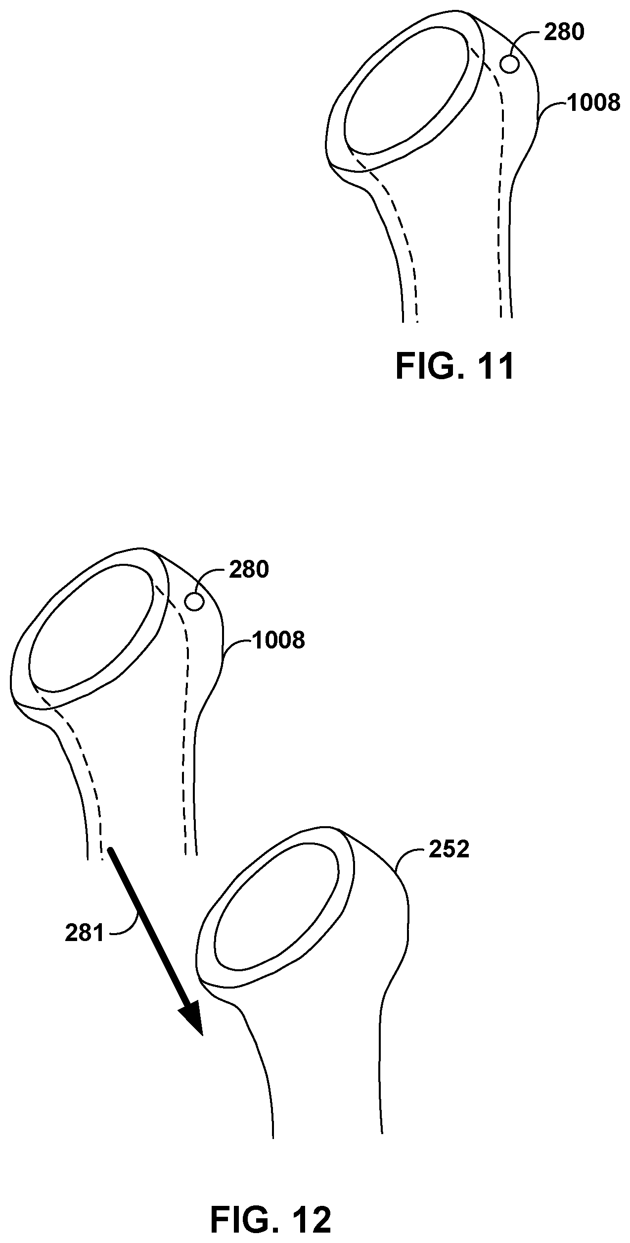 Patent US12551290 Figure 10 – Bone wall tracking and guidance for orthopedic implant placement