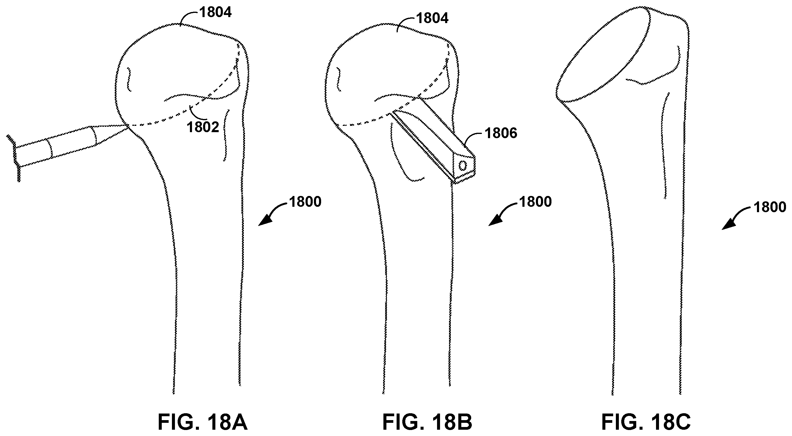Patent US12551290 Figure 14 – Bone wall tracking and guidance for orthopedic implant placement