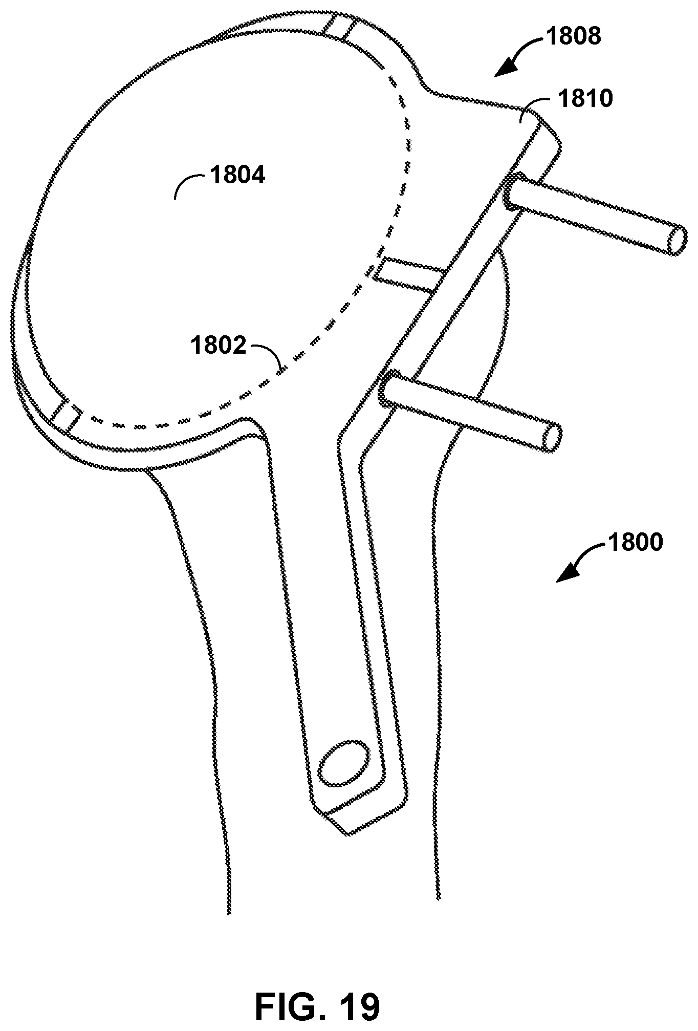 Patent US12551290 Figure 15 – Bone wall tracking and guidance for orthopedic implant placement