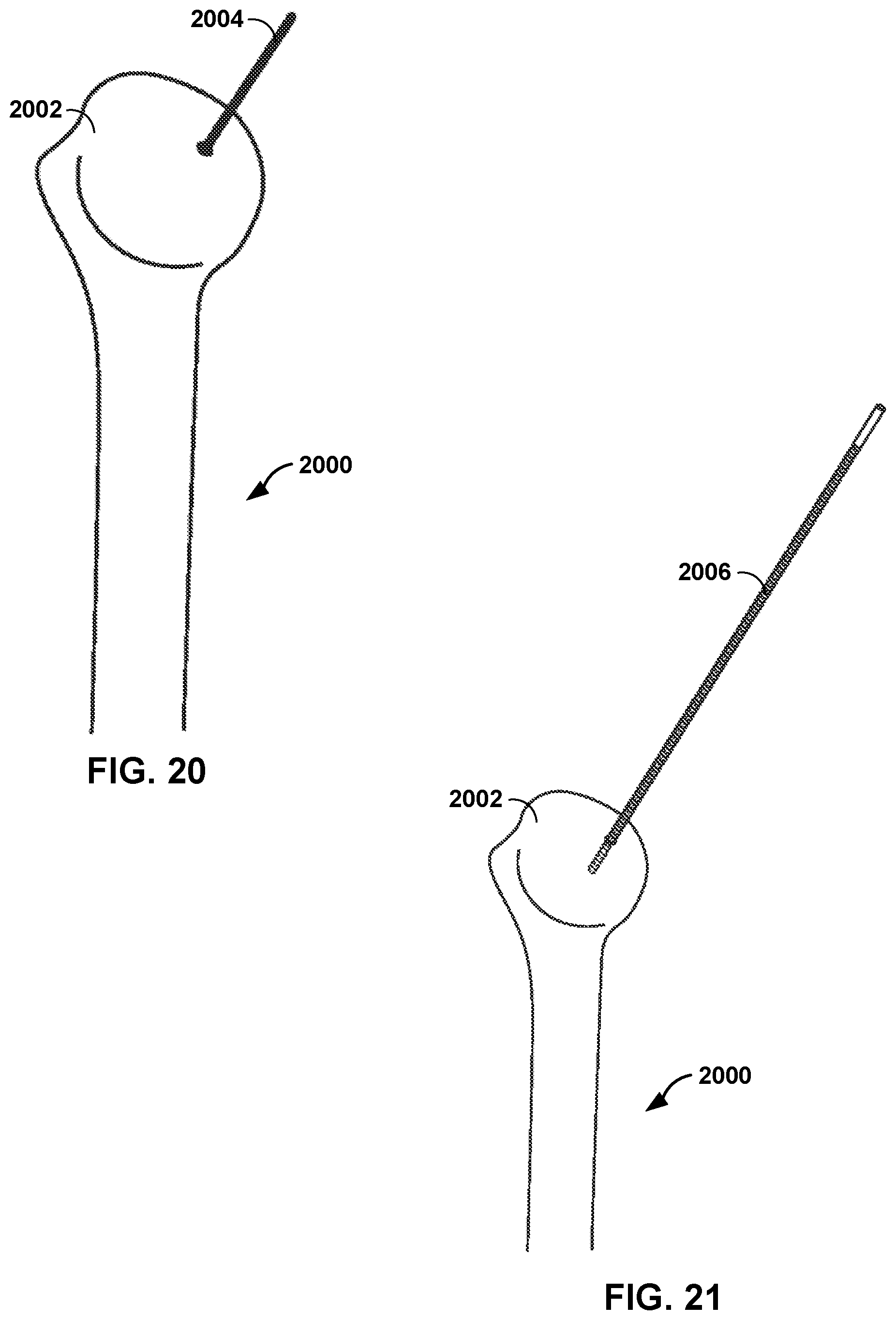 Patent US12551290 Figure 16 – Bone wall tracking and guidance for orthopedic implant placement