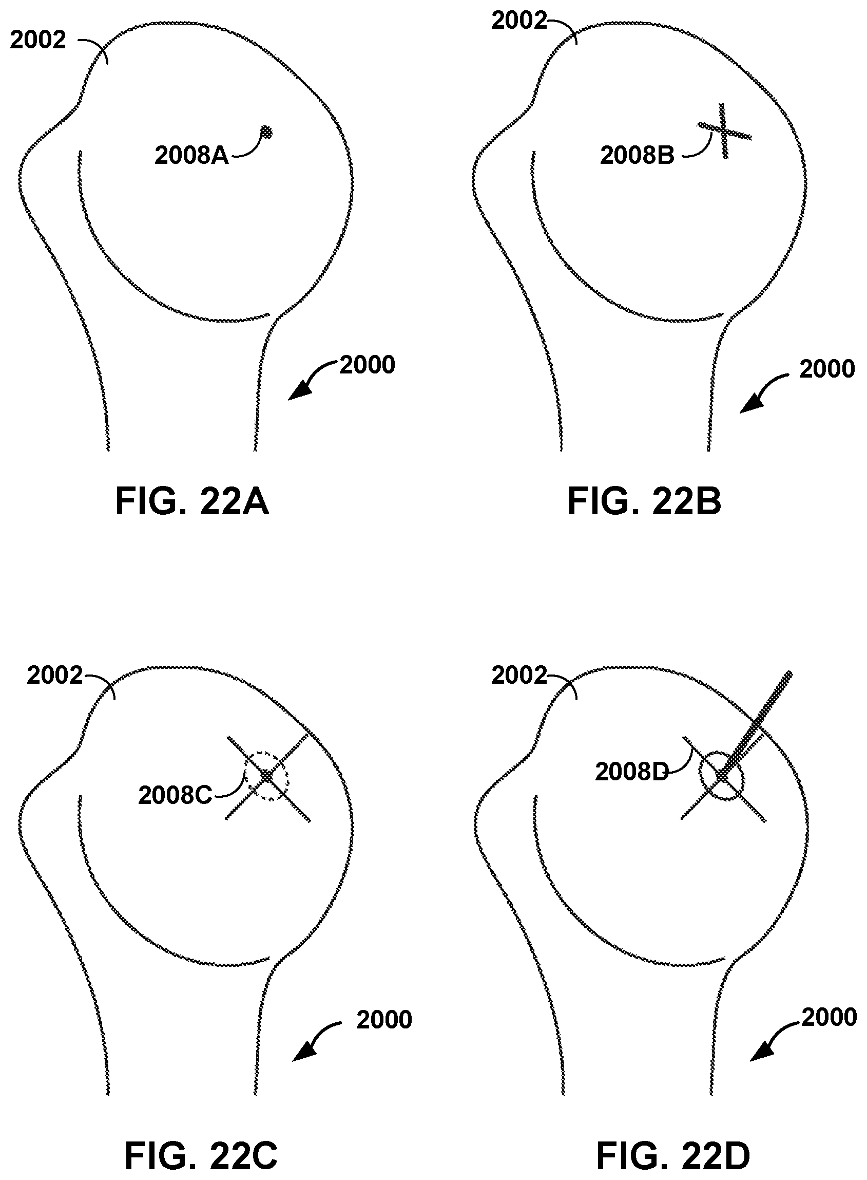 Patent US12551290 Figure 17 – Bone wall tracking and guidance for orthopedic implant placement