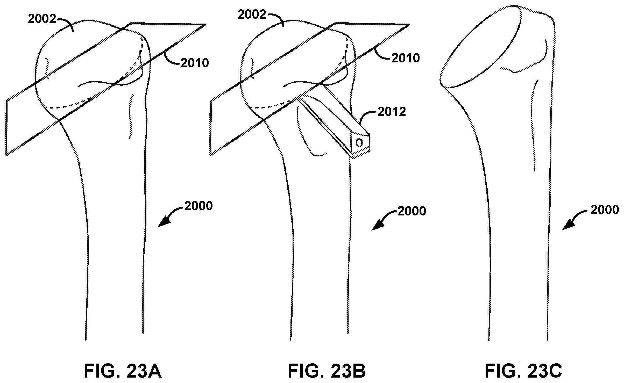 Patent US12551290 Figure 18 – Bone wall tracking and guidance for orthopedic implant placement