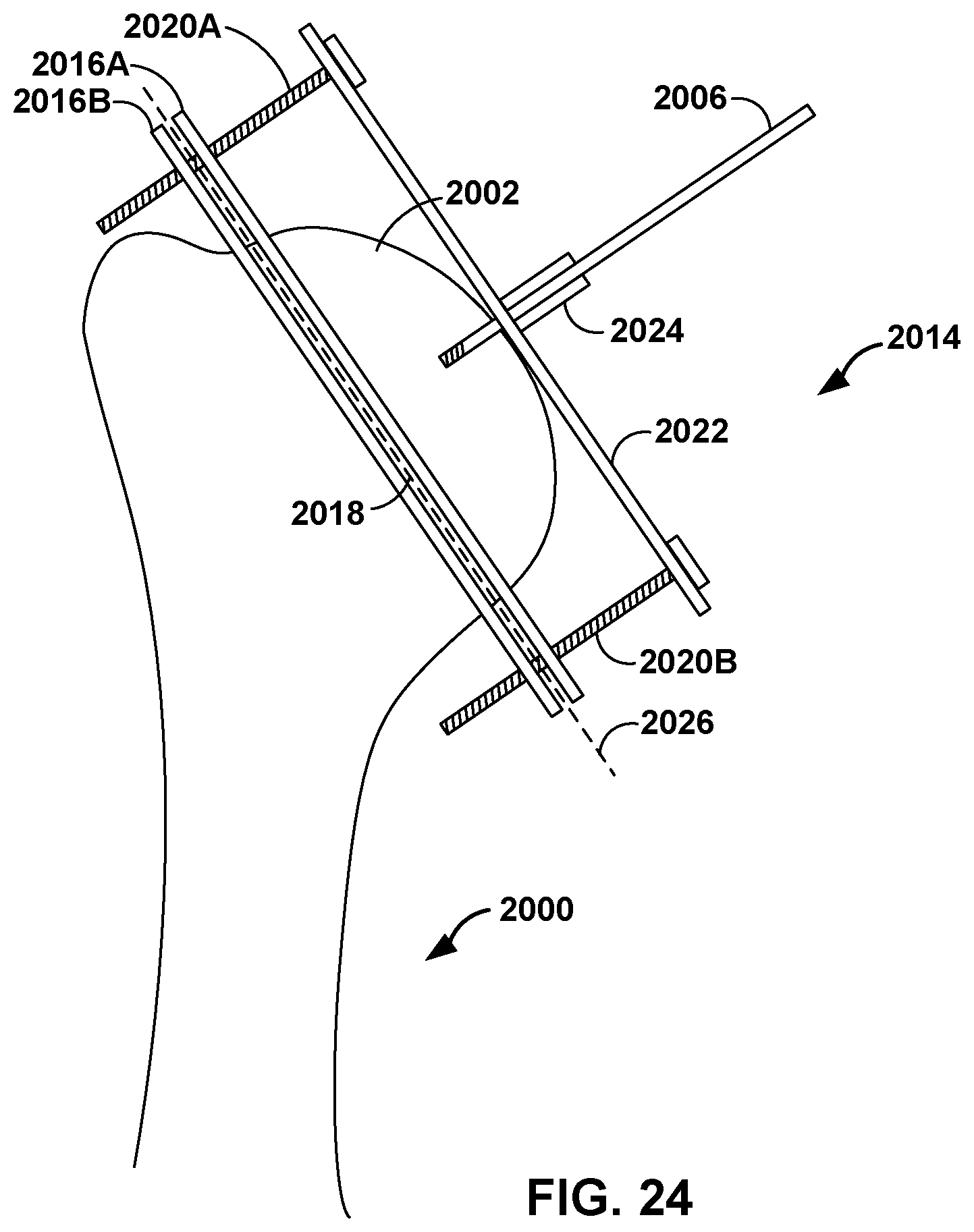 Patent US12551290 Figure 19 – Bone wall tracking and guidance for orthopedic implant placement