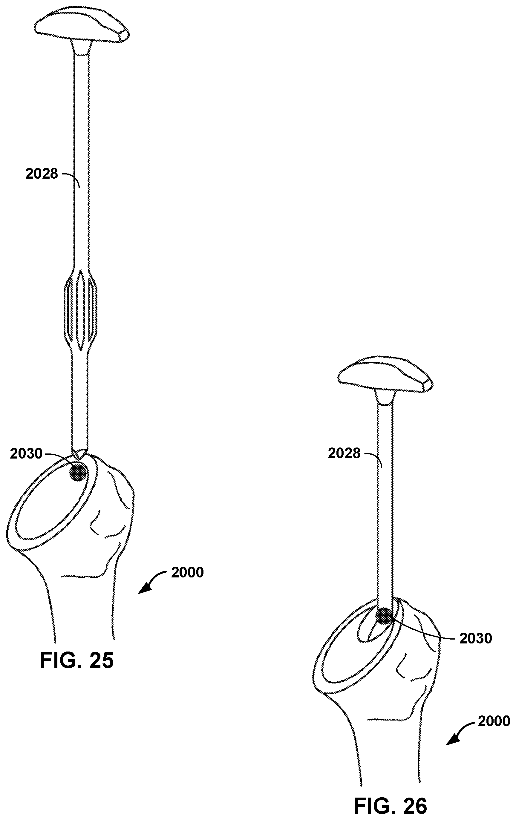 Patent US12551290 Figure 20 – Bone wall tracking and guidance for orthopedic implant placement
