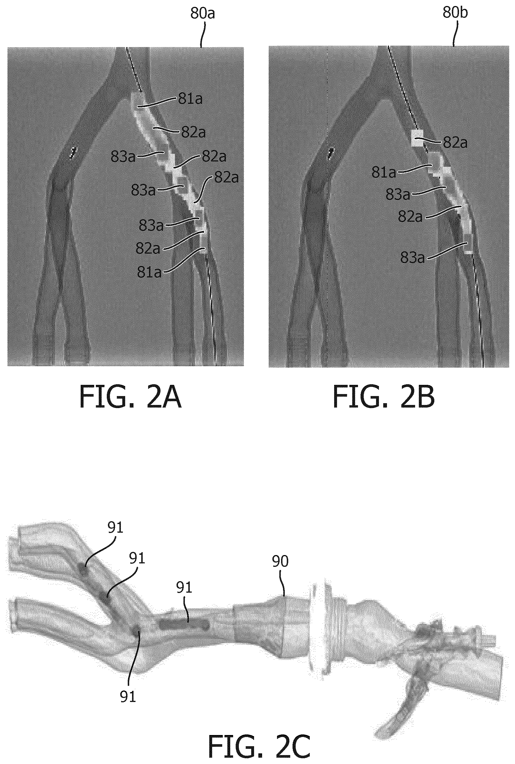 Patent US12551291 Figure 2 – Dwelling treatment monitoring for endoluminal therapy procedures
