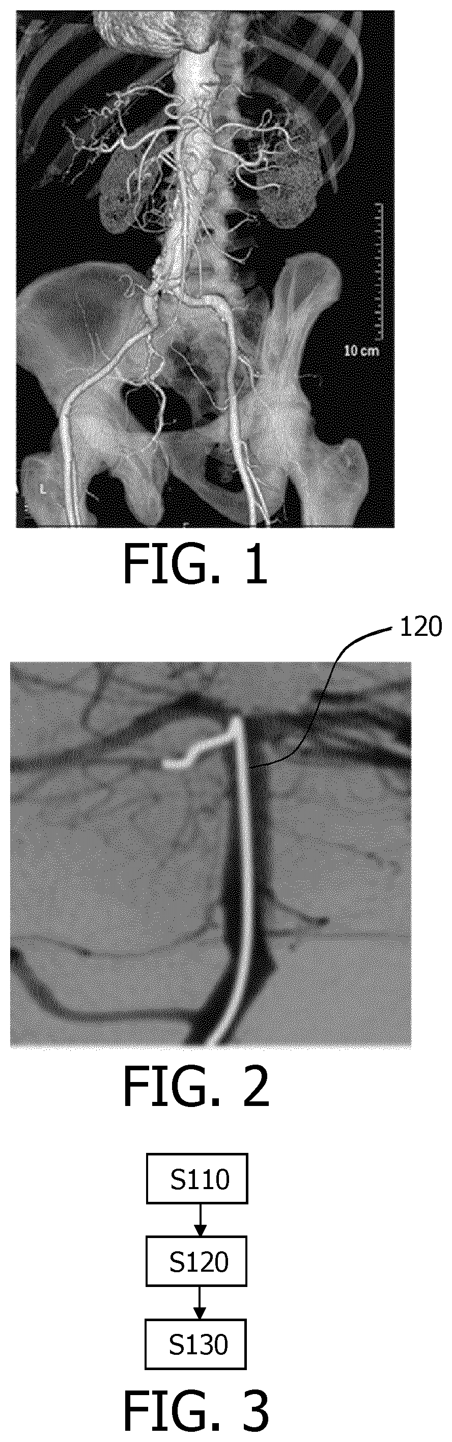 Patent US12551293 — Navigating an interventional device — Figure 1