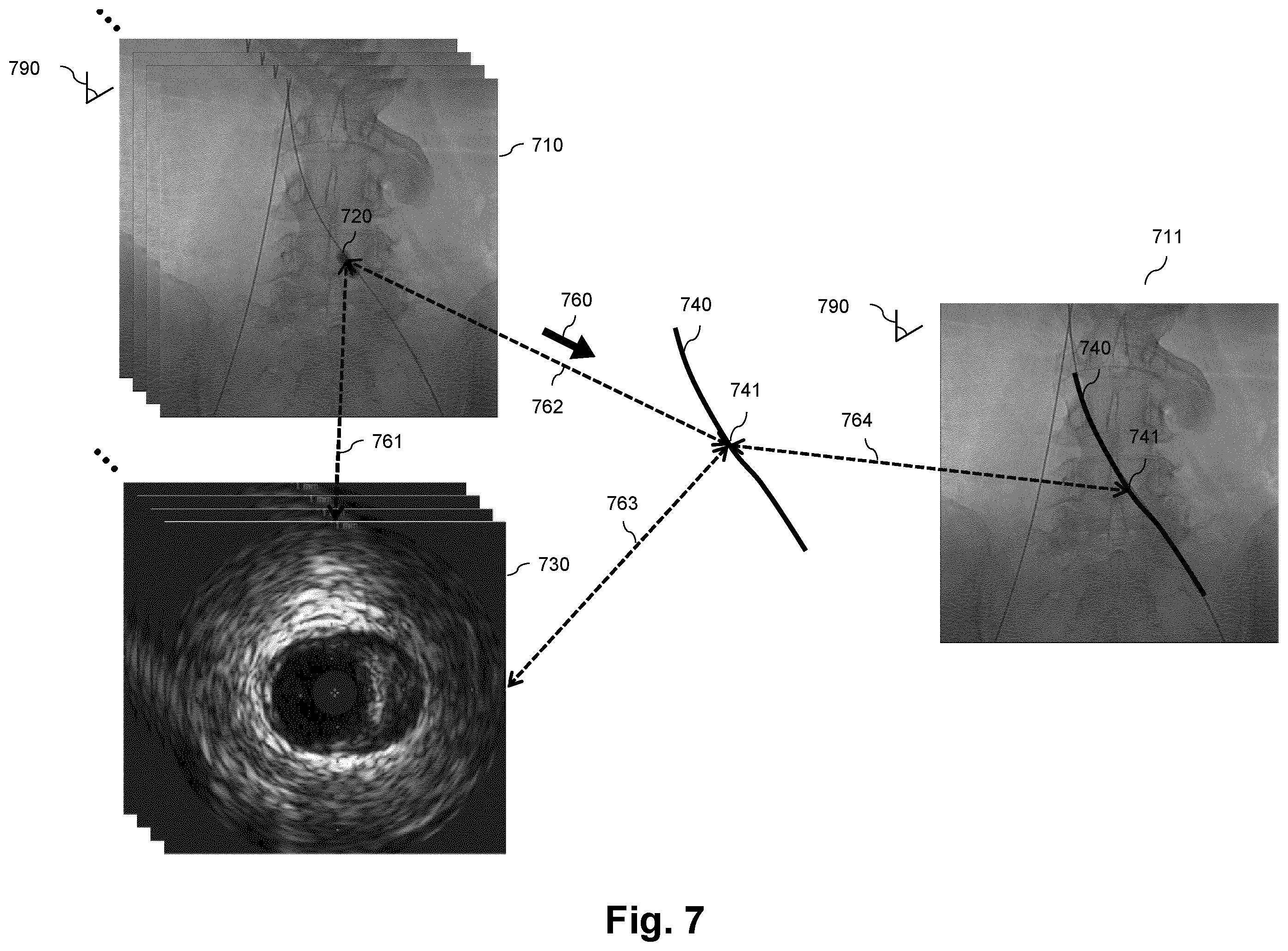 Patent US12551294 Figure 7 – Intraluminal treatment guidance prior extraluminal imaging, intraluminal data, and coregistration