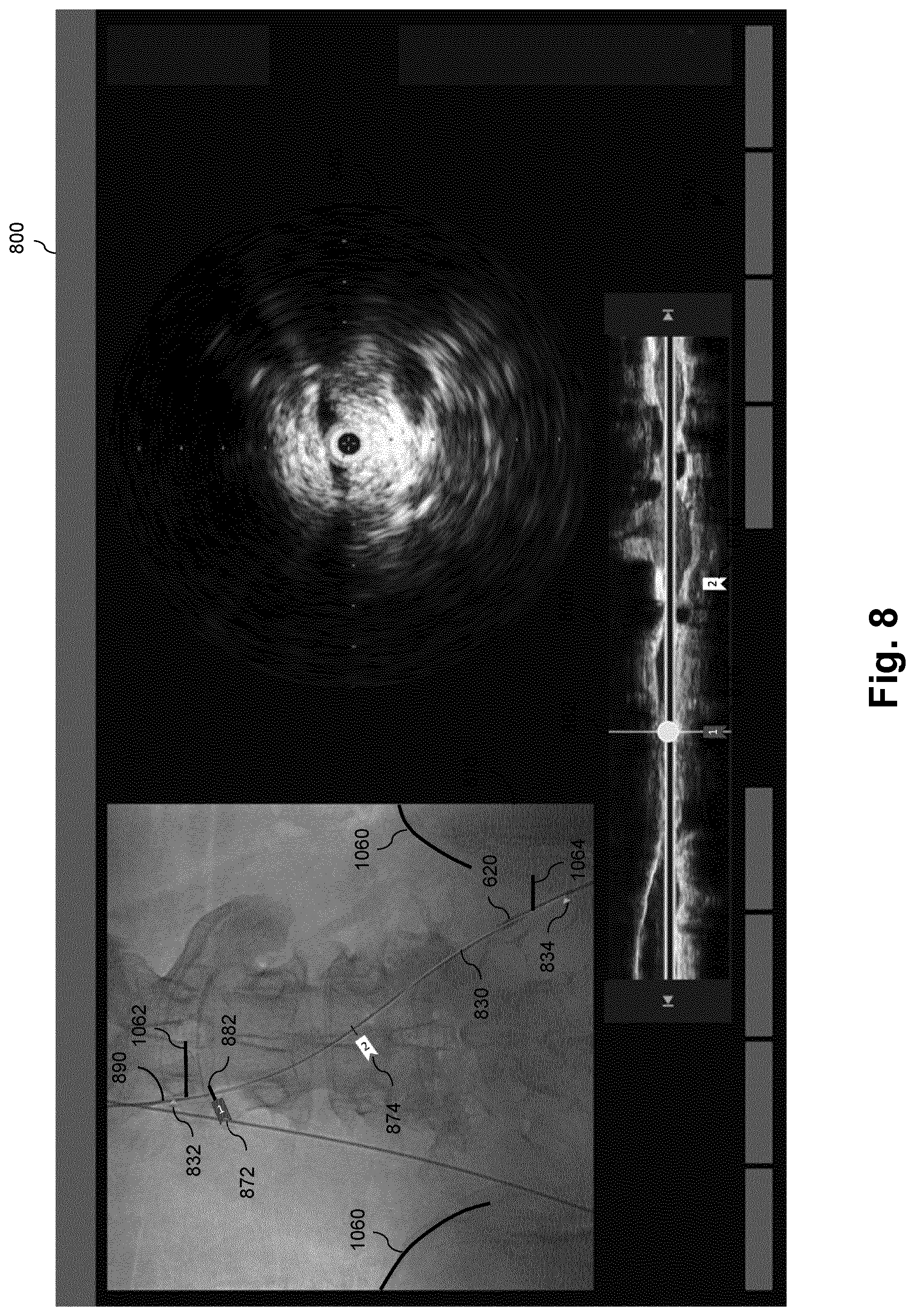 Patent US12551294 Figure 8 – Intraluminal treatment guidance prior extraluminal imaging, intraluminal data, and coregistration