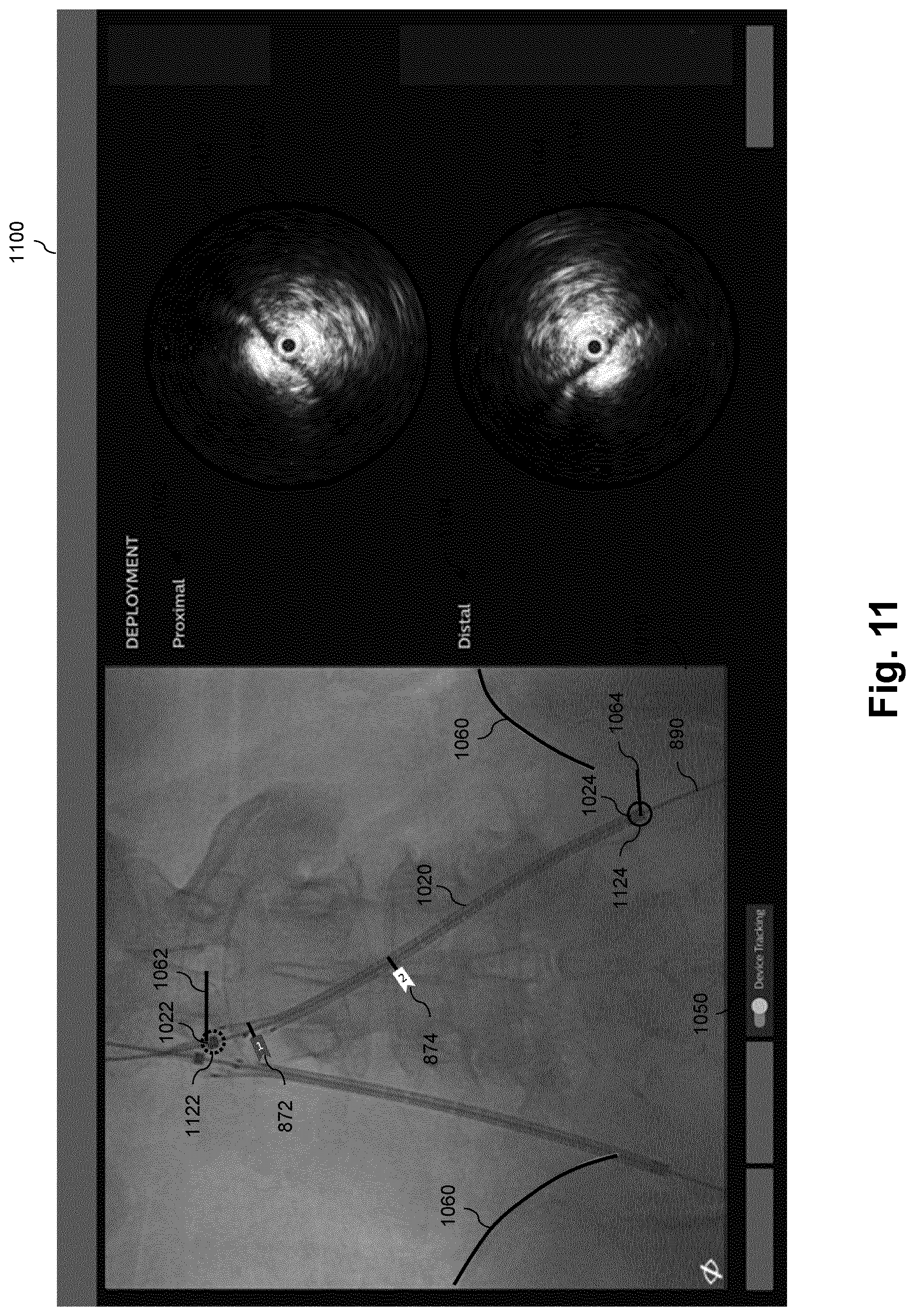 Patent US12551294 Figure 11 – Intraluminal treatment guidance prior extraluminal imaging, intraluminal data, and coregistration