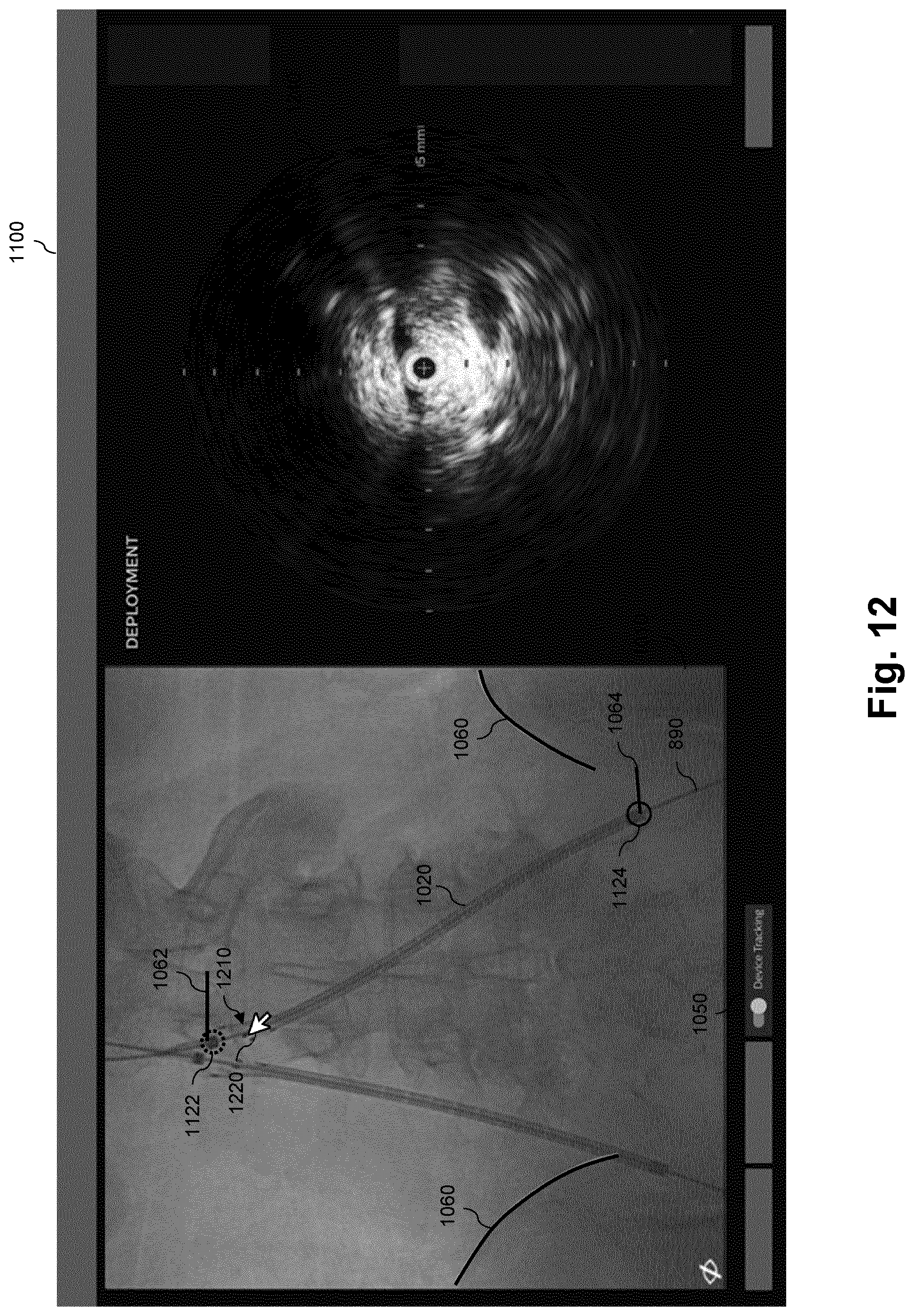Patent US12551294 Figure 12 – Intraluminal treatment guidance prior extraluminal imaging, intraluminal data, and coregistration