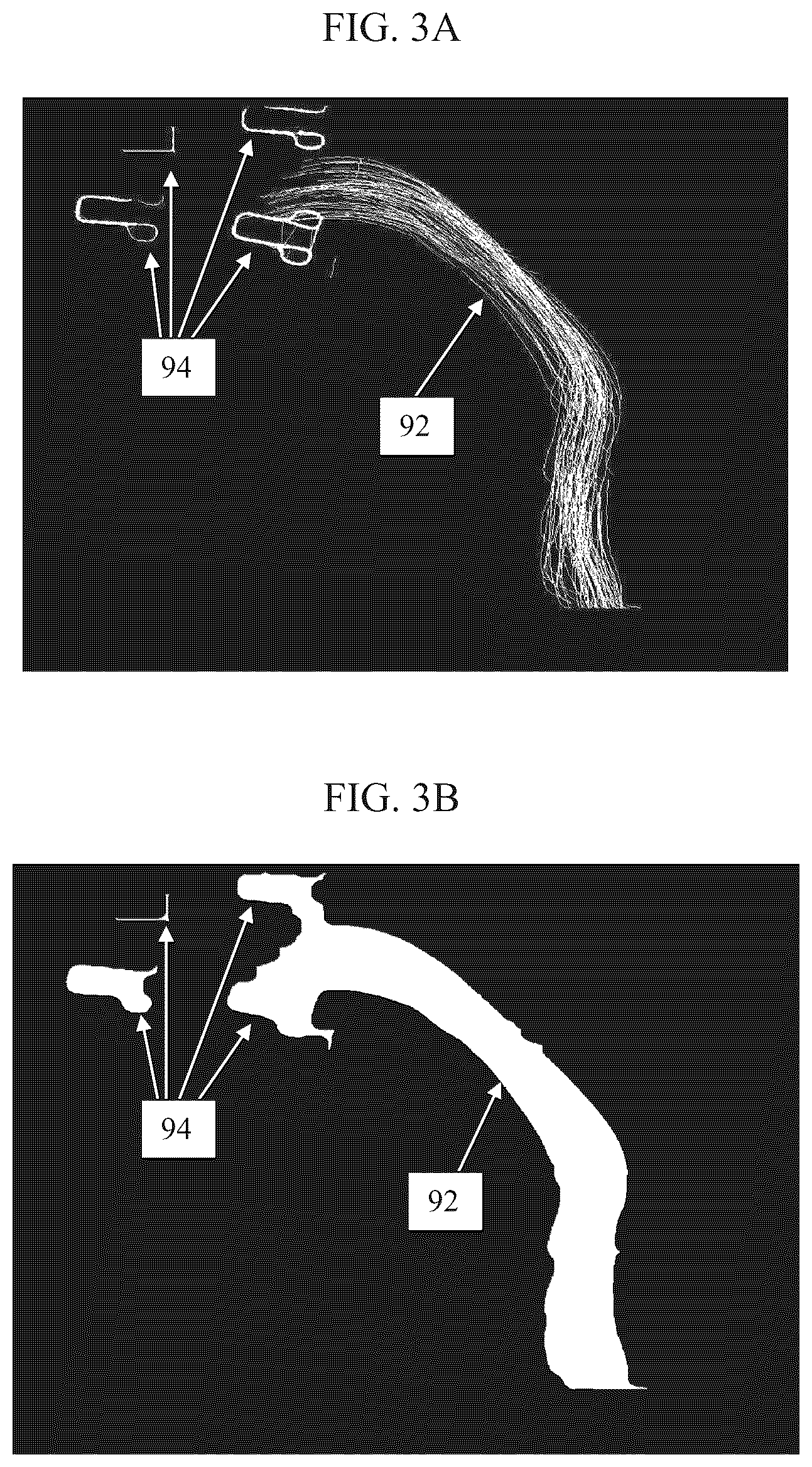 Patent US12551296 Figure 4 – Estimating the endoluminal path of an endoluminal device along a lumen
