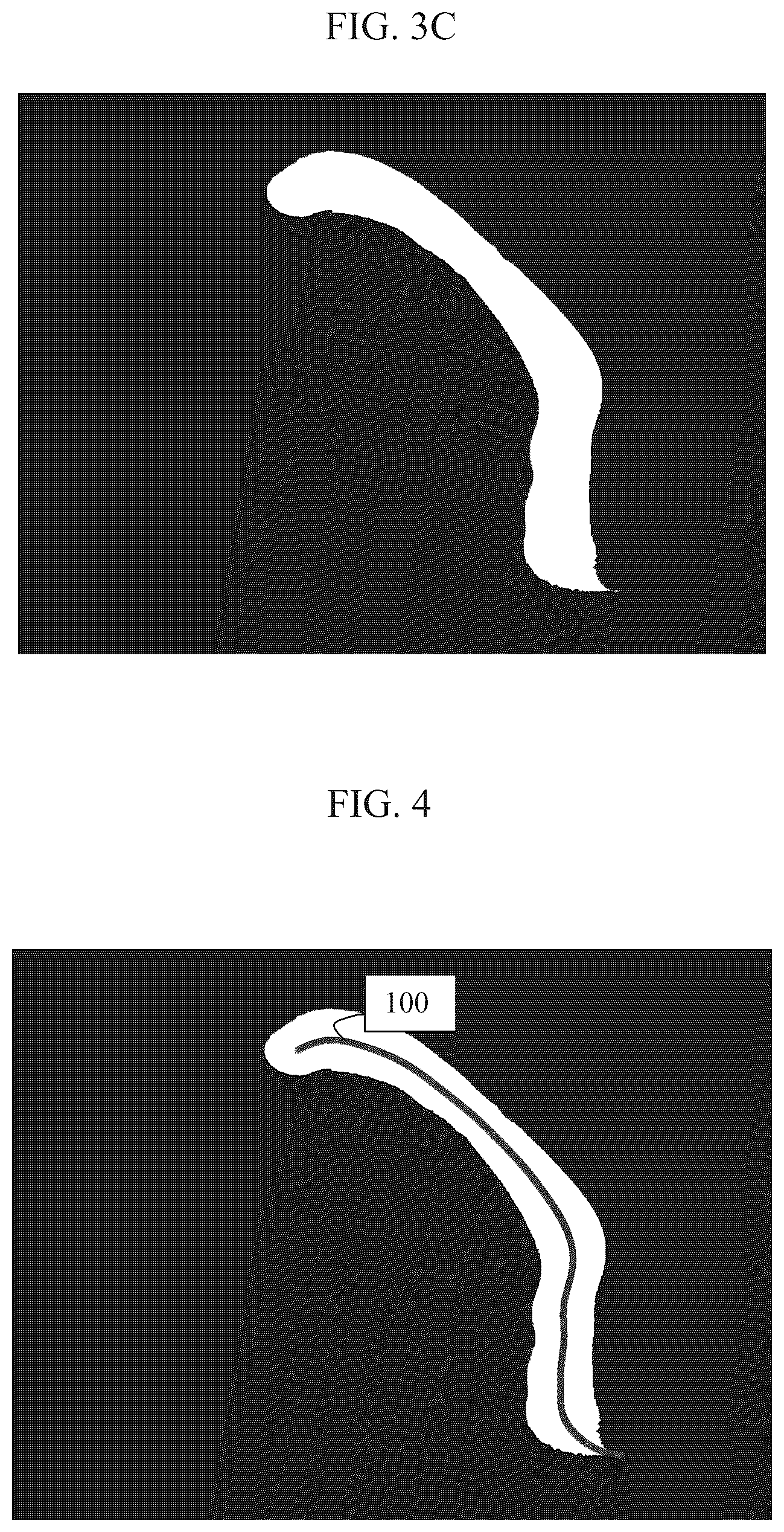 Patent US12551296 Figure 5 – Estimating the endoluminal path of an endoluminal device along a lumen