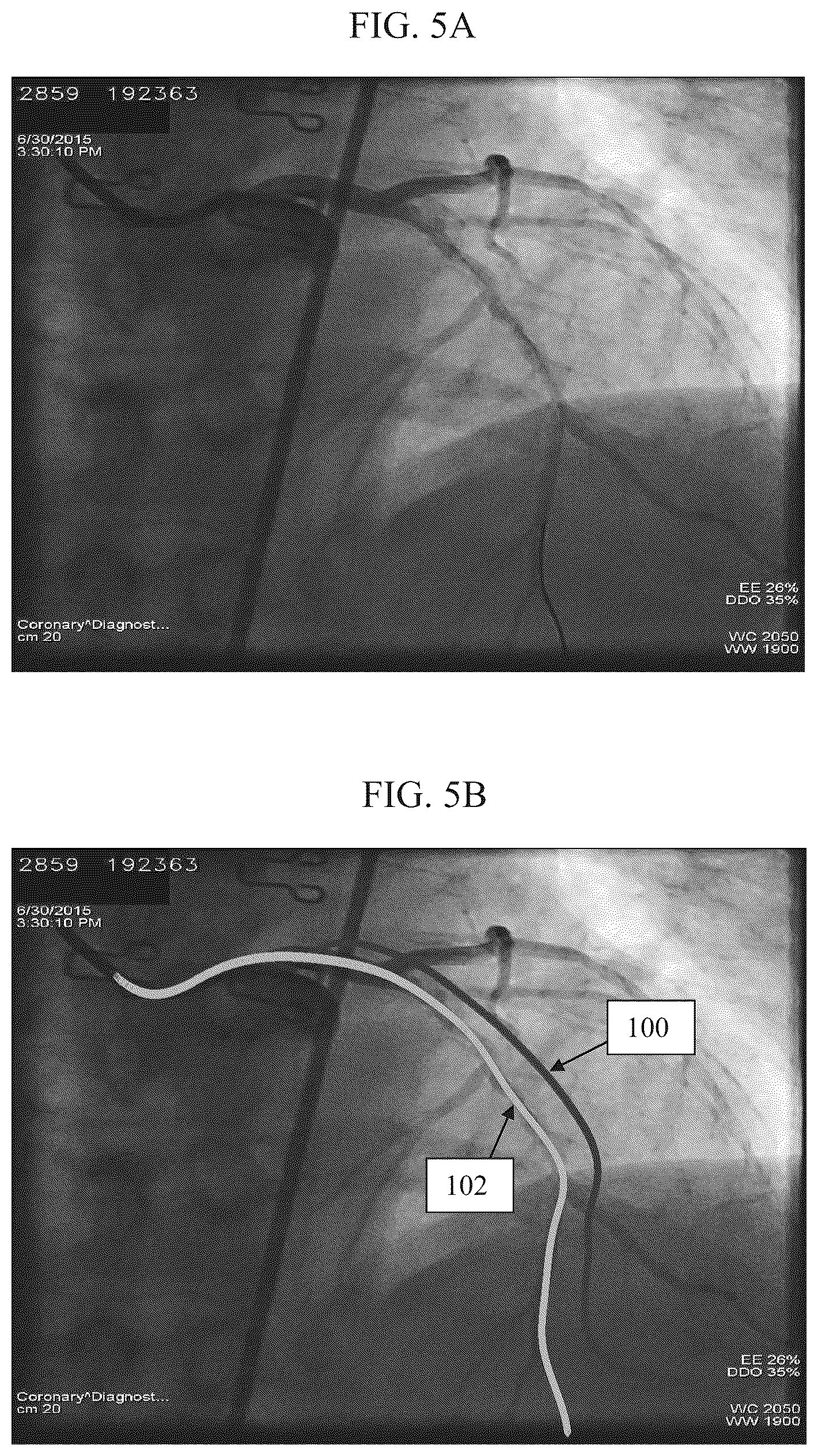 Patent US12551296 Figure 6 – Estimating the endoluminal path of an endoluminal device along a lumen
