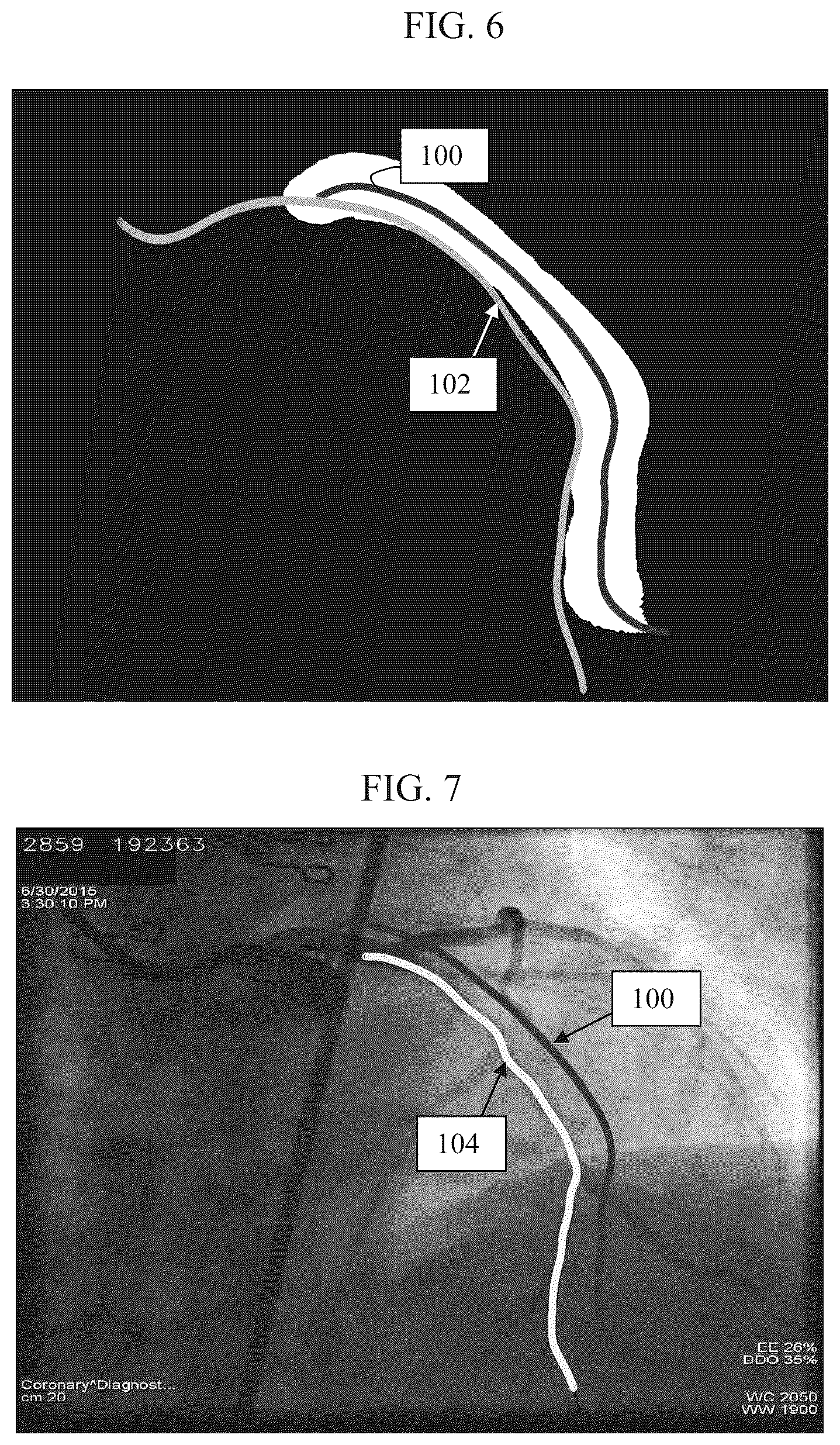Patent US12551296 Figure 7 – Estimating the endoluminal path of an endoluminal device along a lumen