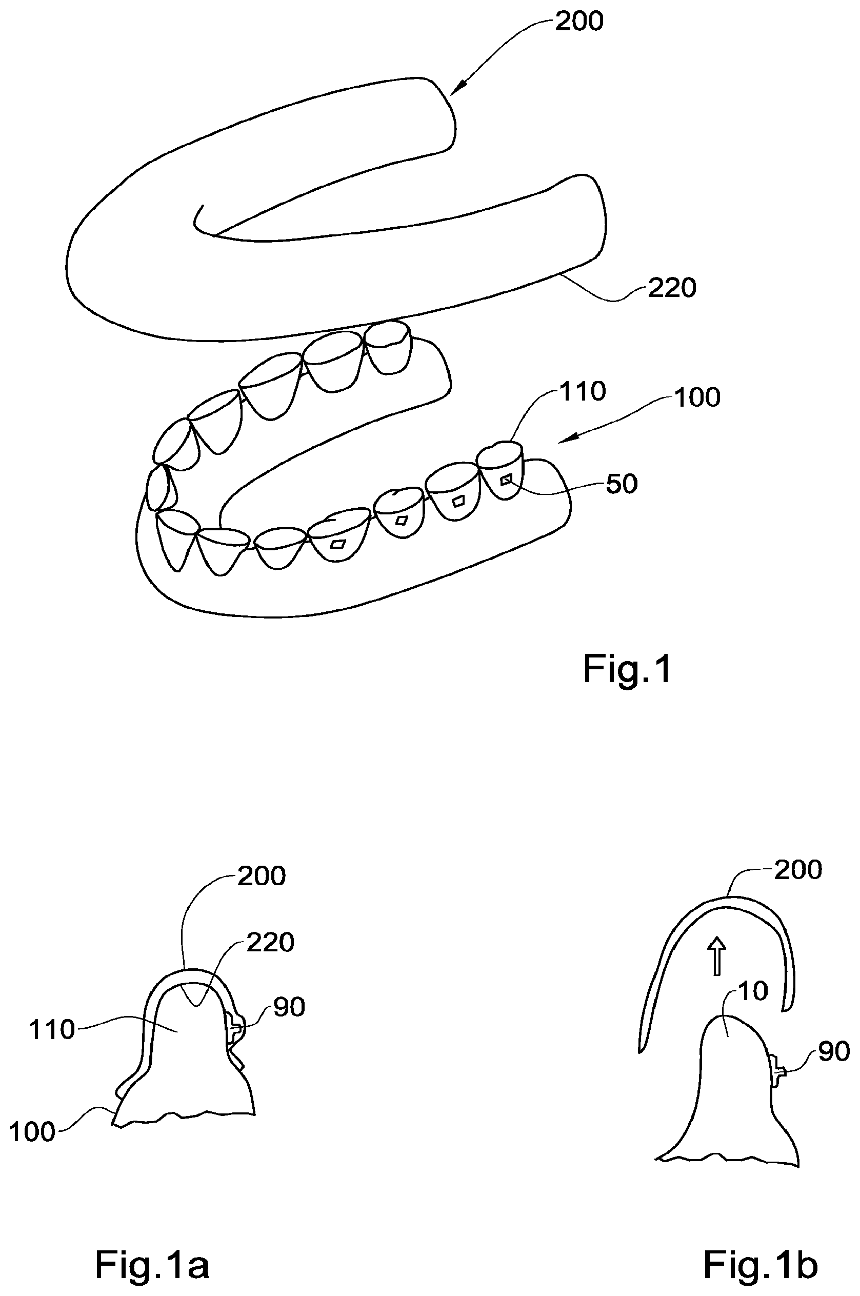 Patent US12551318 — Method, system and model for indirect bonding — Figure 1