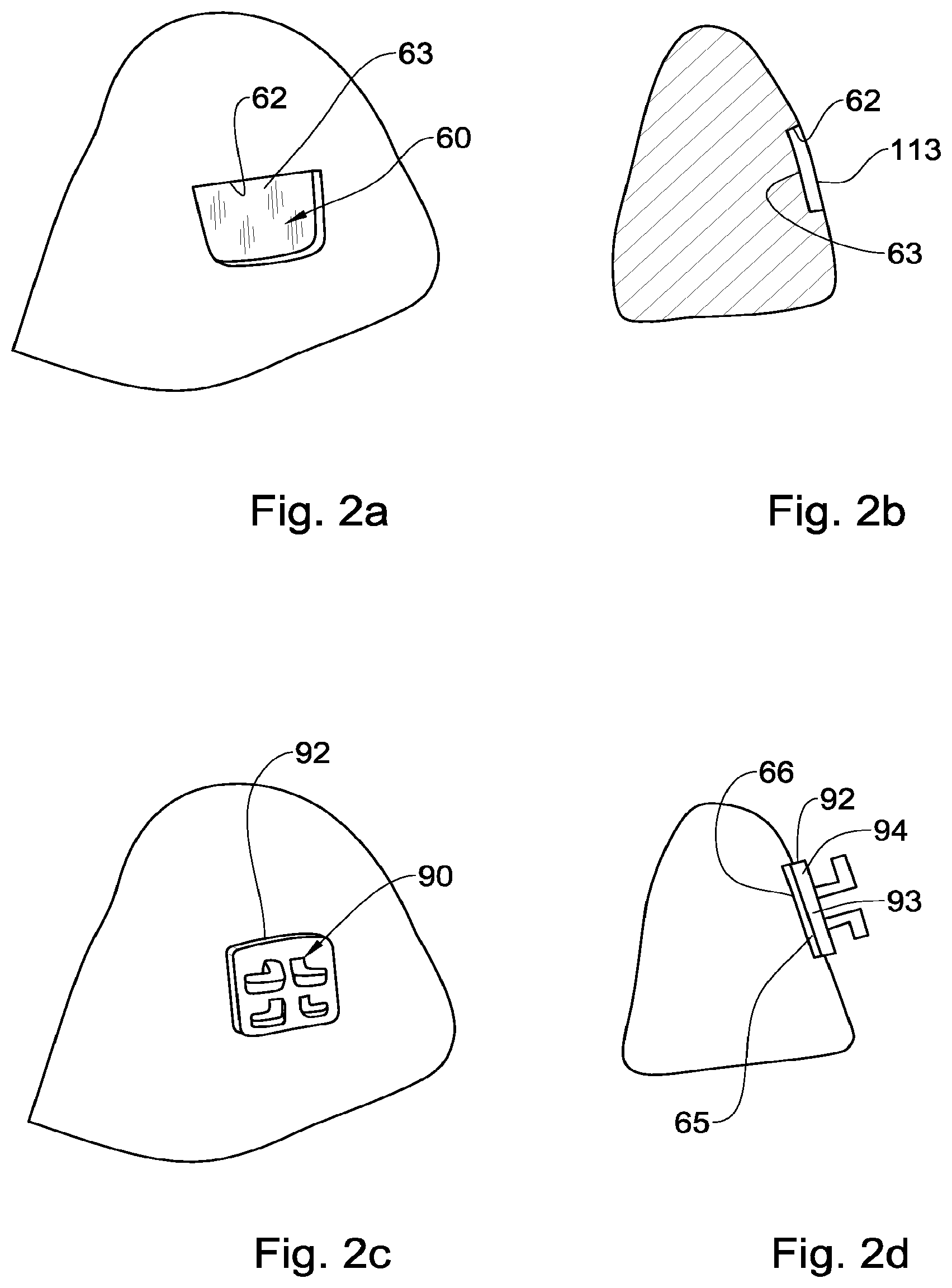 Patent US12551318 Figure 2 – Method, system and model for indirect bonding