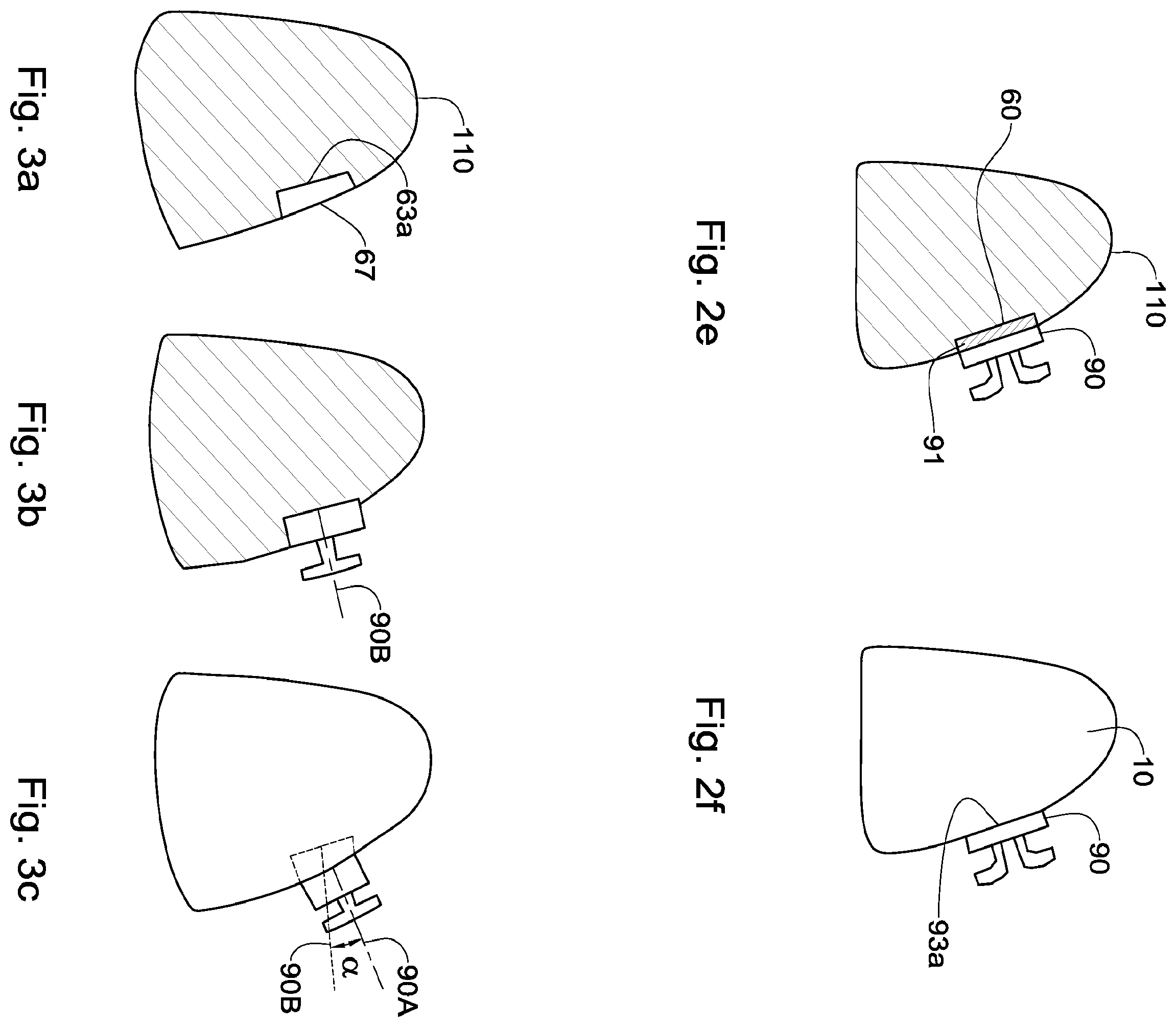 Patent US12551318 Figure 3 – Method, system and model for indirect bonding
