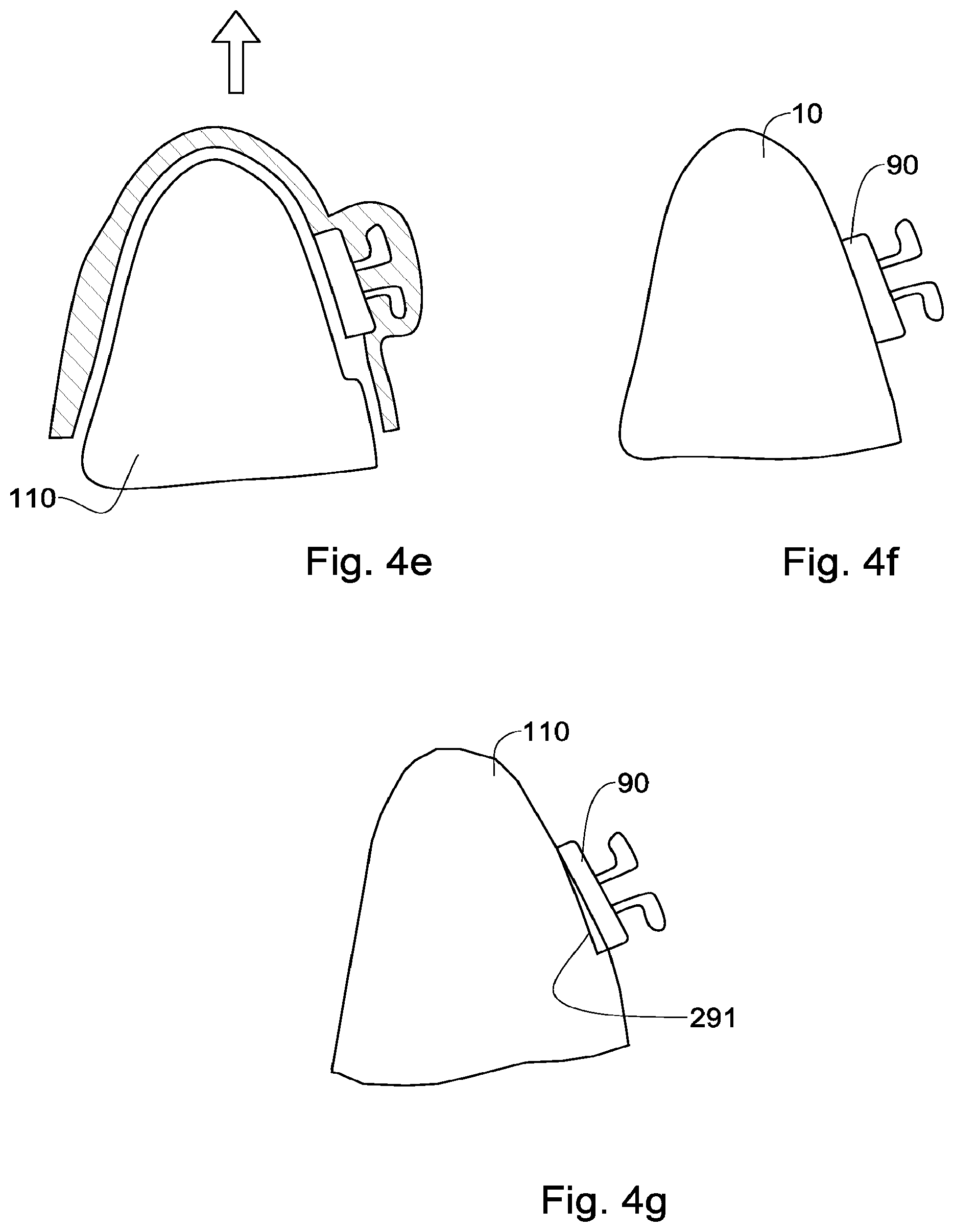 Patent US12551318 Figure 5 – Method, system and model for indirect bonding