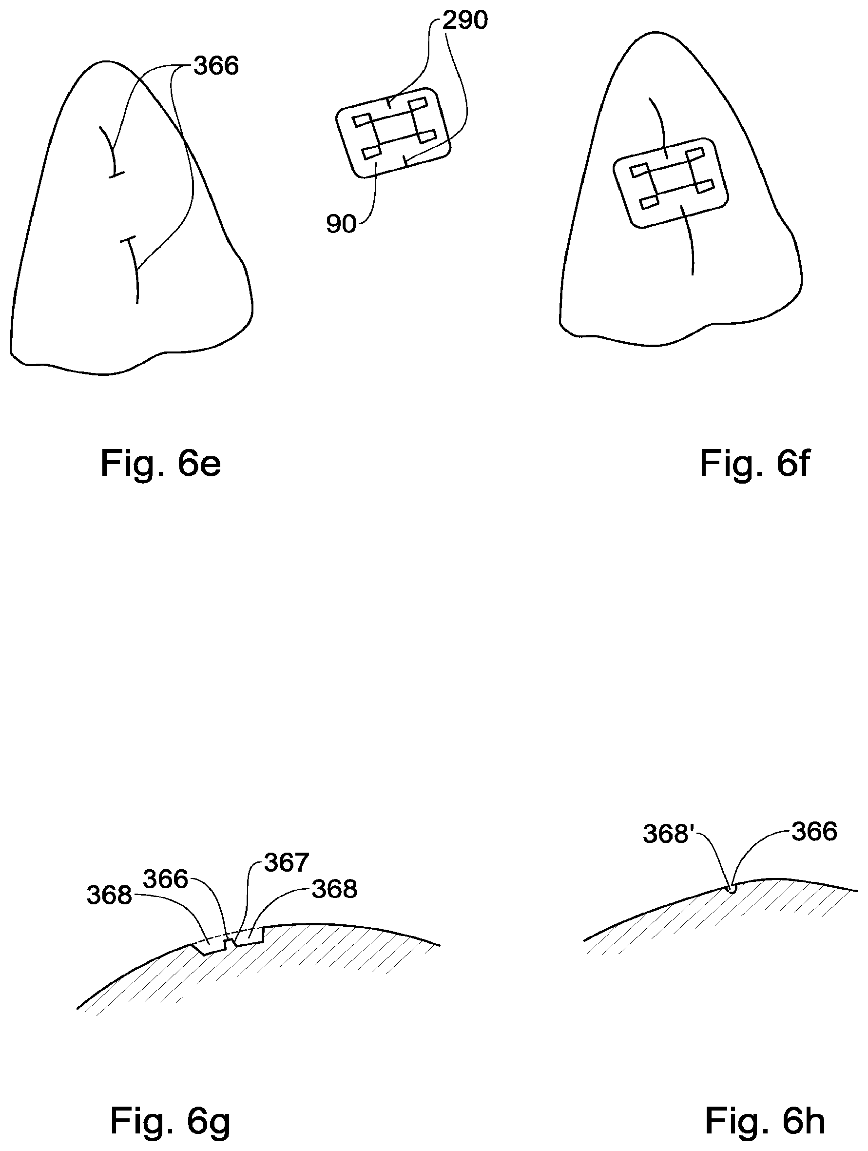 Patent US12551318 Figure 8 – Method, system and model for indirect bonding