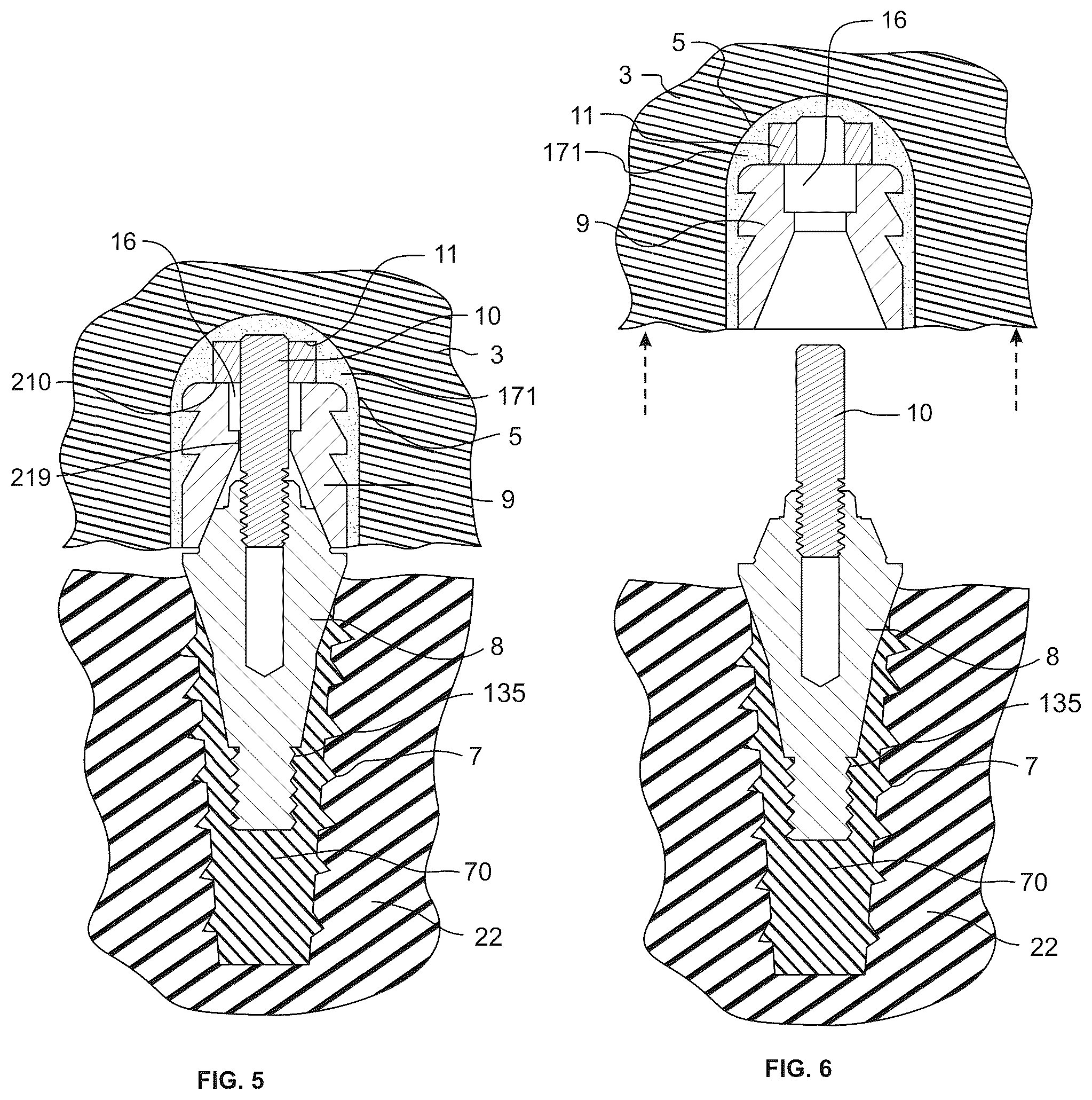 Patent US12551319 Figure 3 – Screw-attached pick-up dental coping system and methods