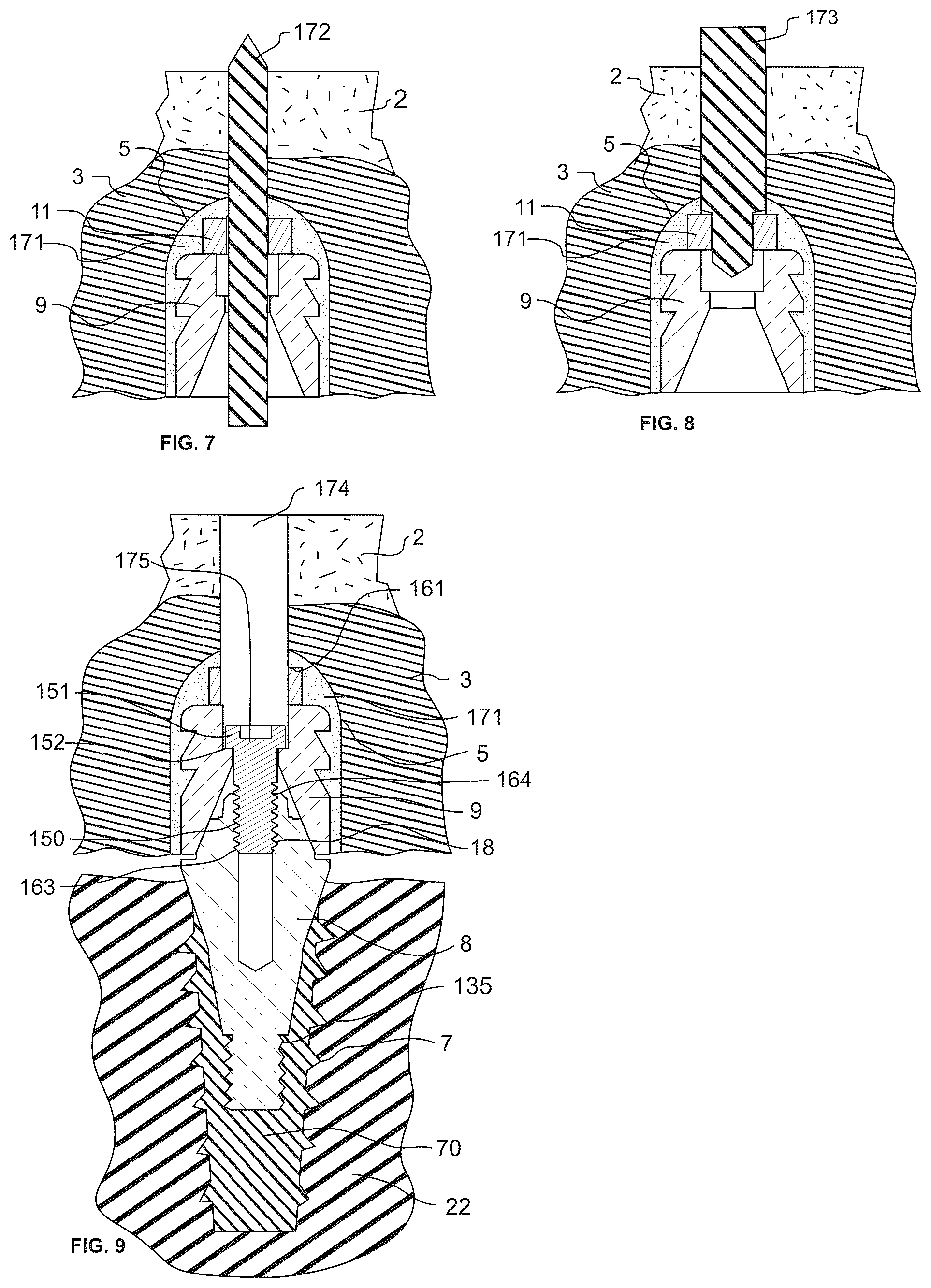 Patent US12551319 Figure 4 – Screw-attached pick-up dental coping system and methods