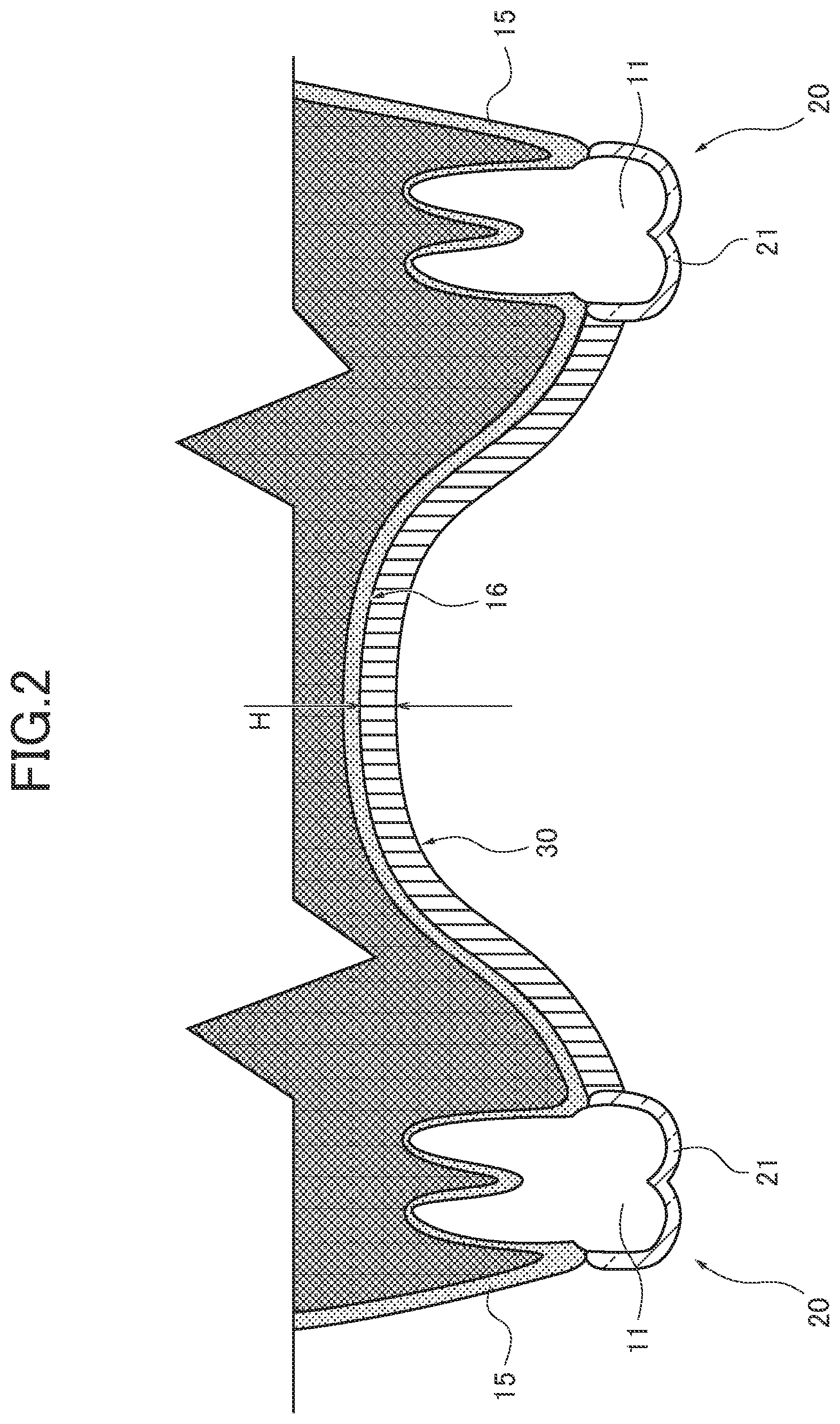 Patent US12551321 Figure 2 – Dental intraoral device and manufacturing method thereof