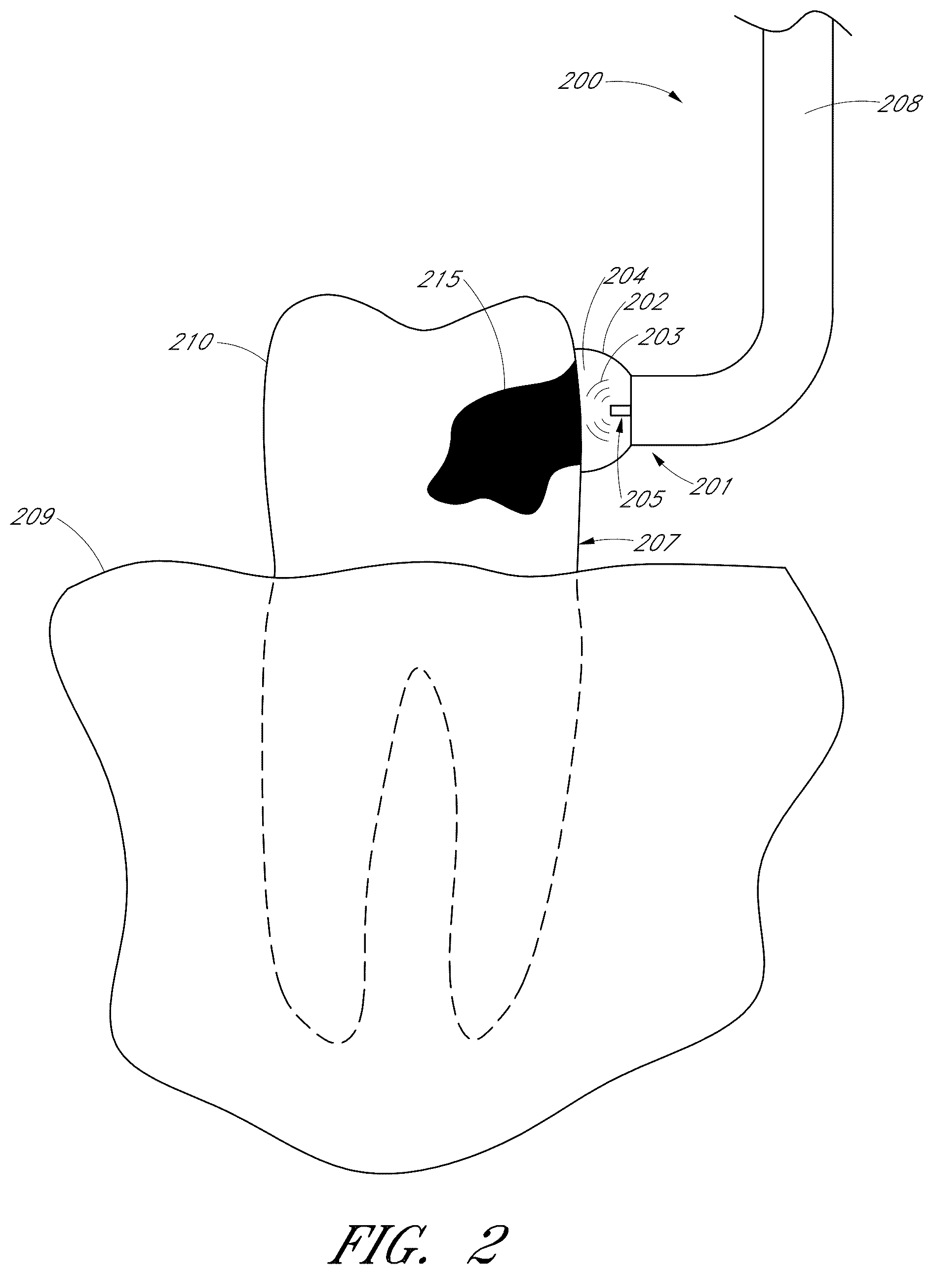 Patent US12551322 Figure 3 – Apparatus and methods for cleaning teeth