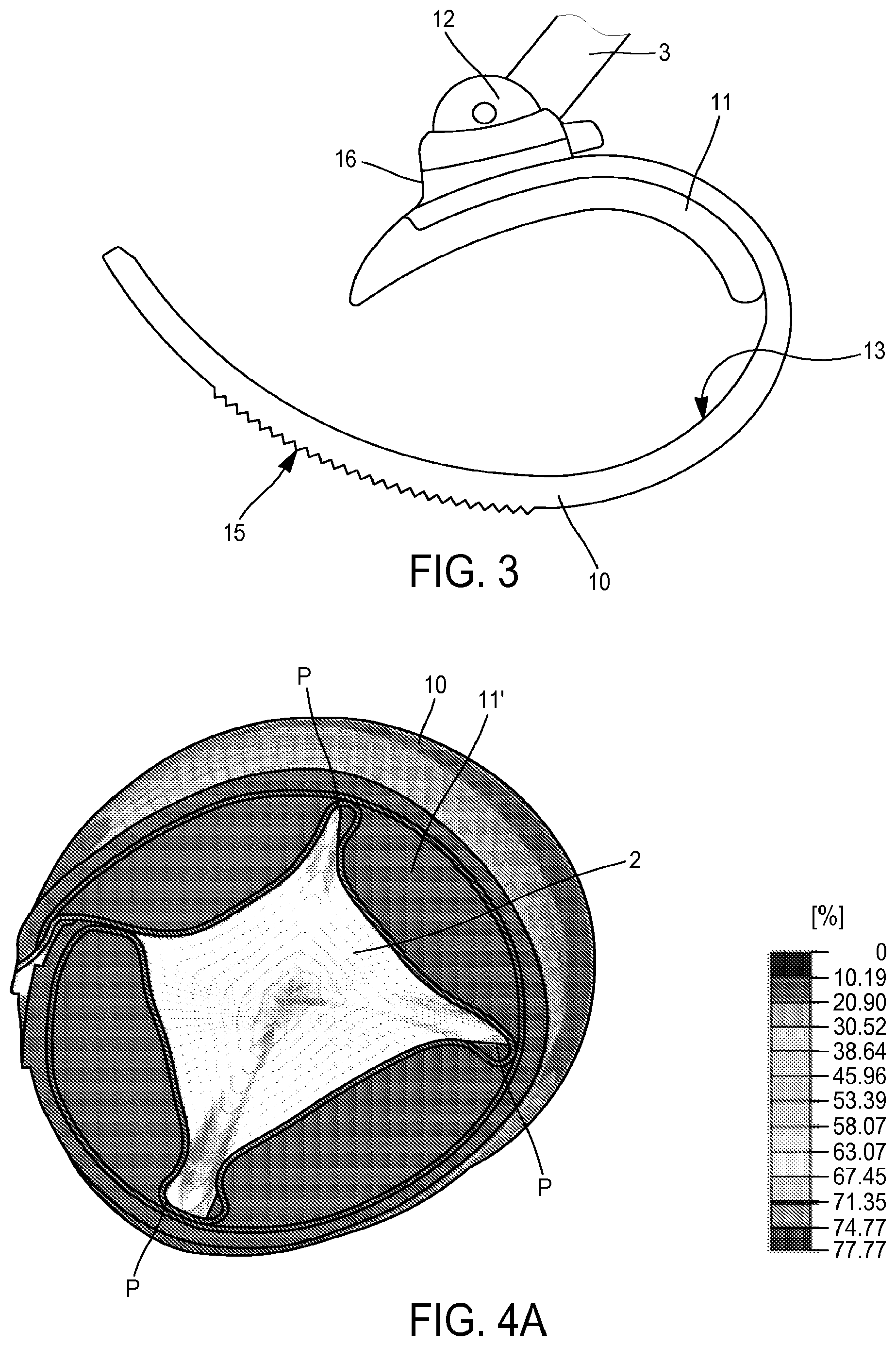 Patent US12551324 Figure 2 – Occlusive cuff and implantable occlusive system comprising such a cuff