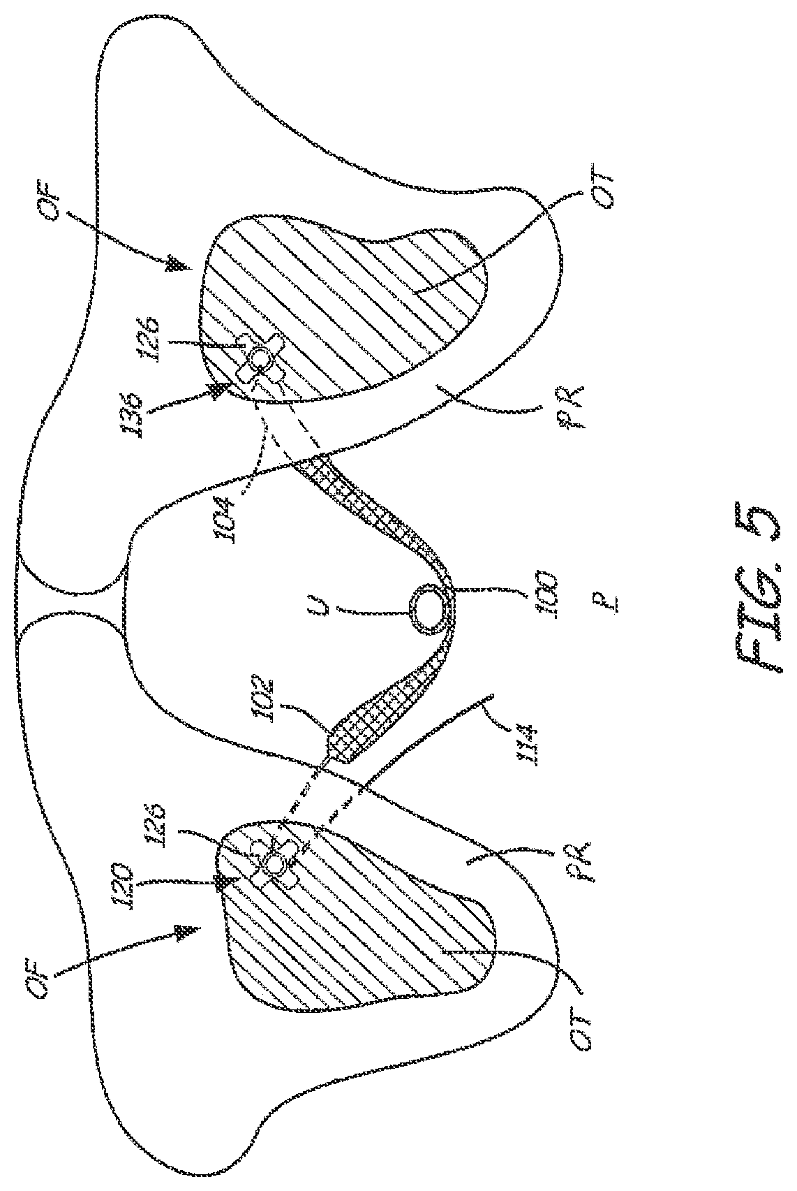 Patent US12551325 Figure 4 – Method of treating urinary incontinence in a patient by placing a sling in a single vaginal incision