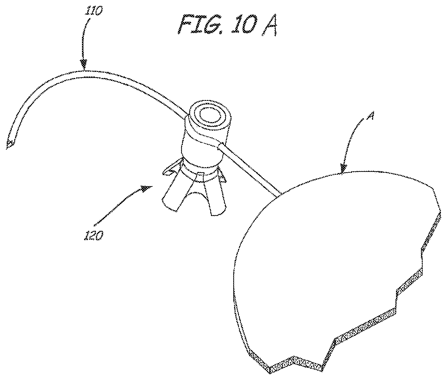 Patent US12551325 Figure 8 – Method of treating urinary incontinence in a patient by placing a sling in a single vaginal incision