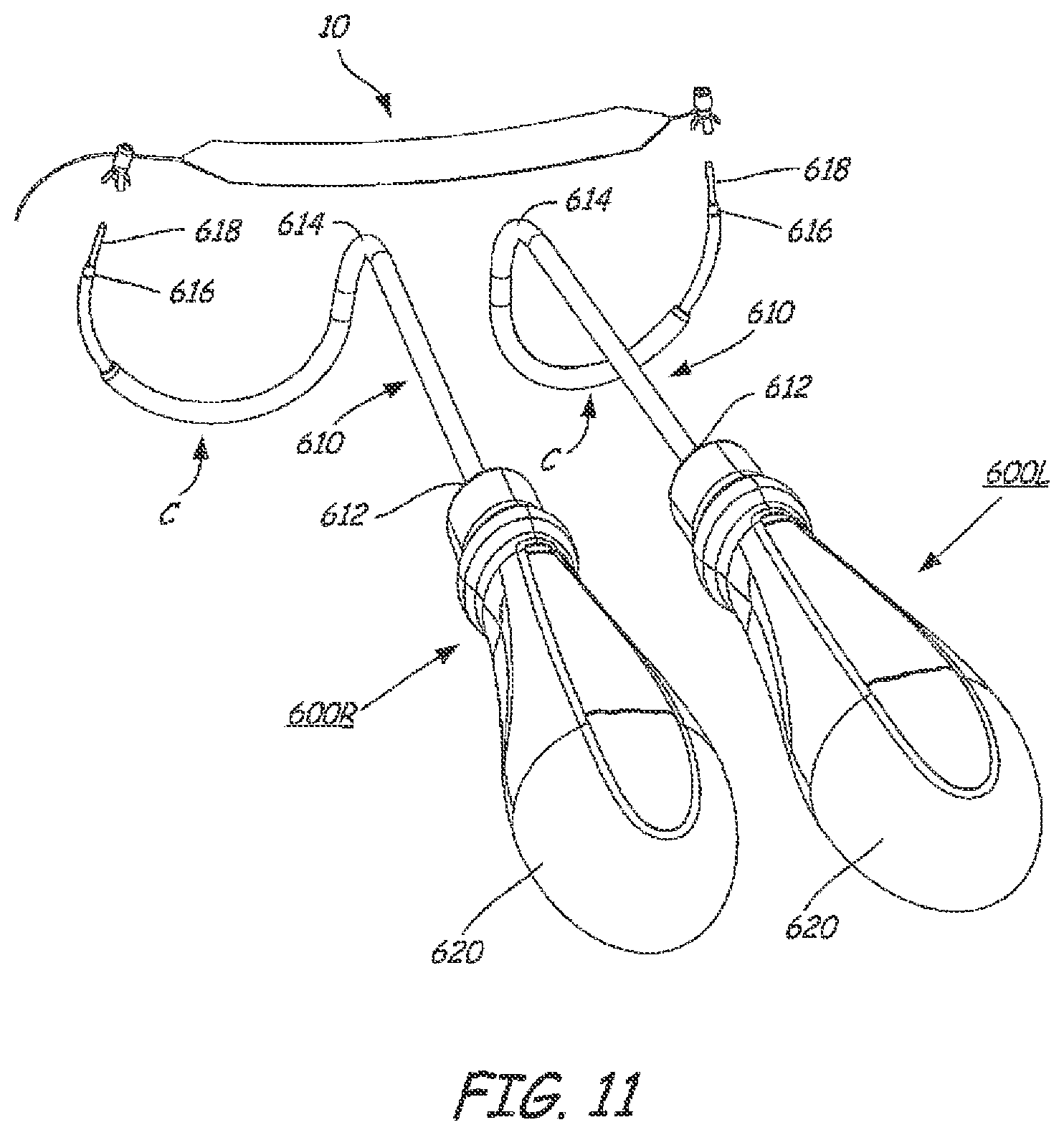 Patent US12551325 Figure 11 – Method of treating urinary incontinence in a patient by placing a sling in a single vaginal incision