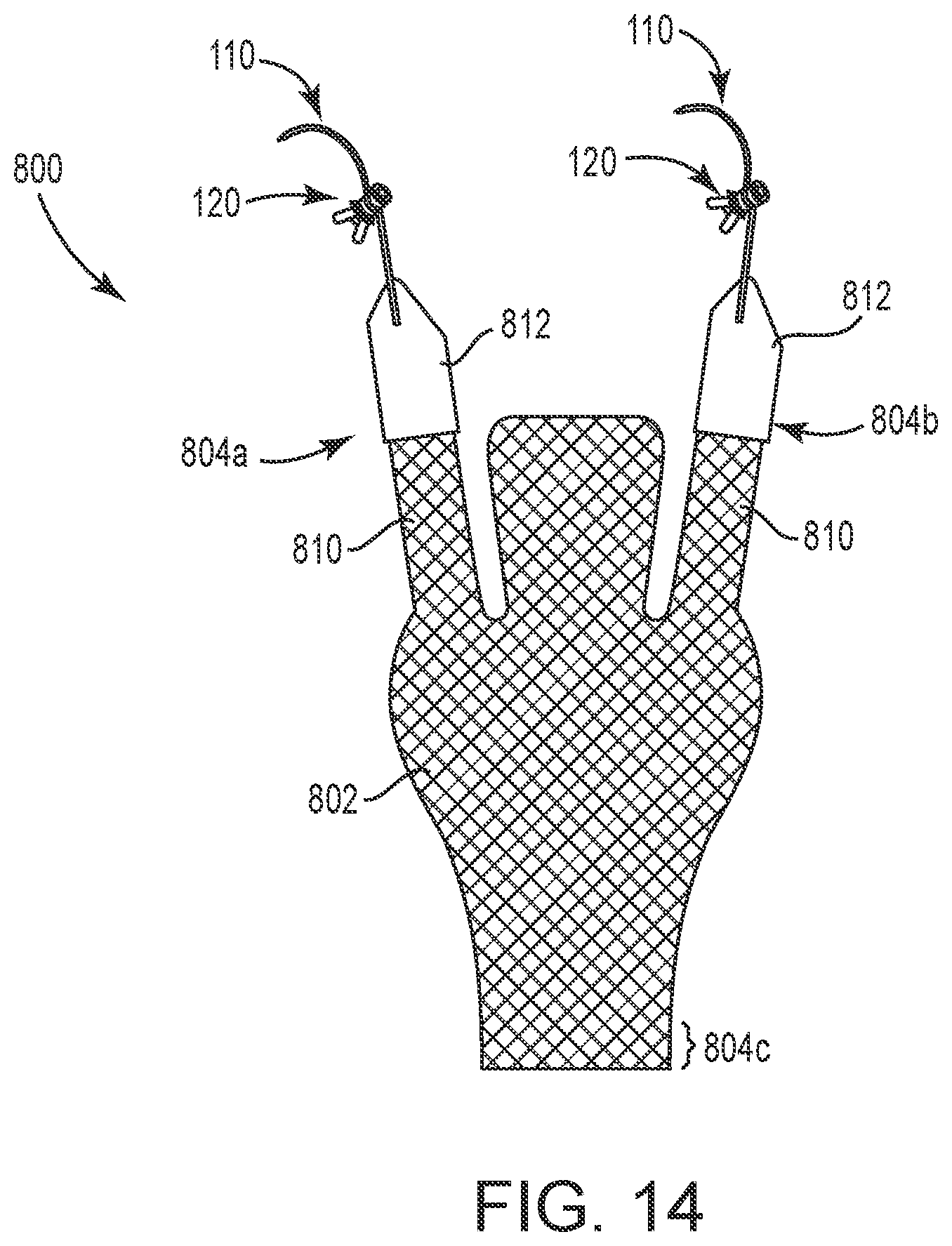 Patent US12551325 Figure 14 – Method of treating urinary incontinence in a patient by placing a sling in a single vaginal incision