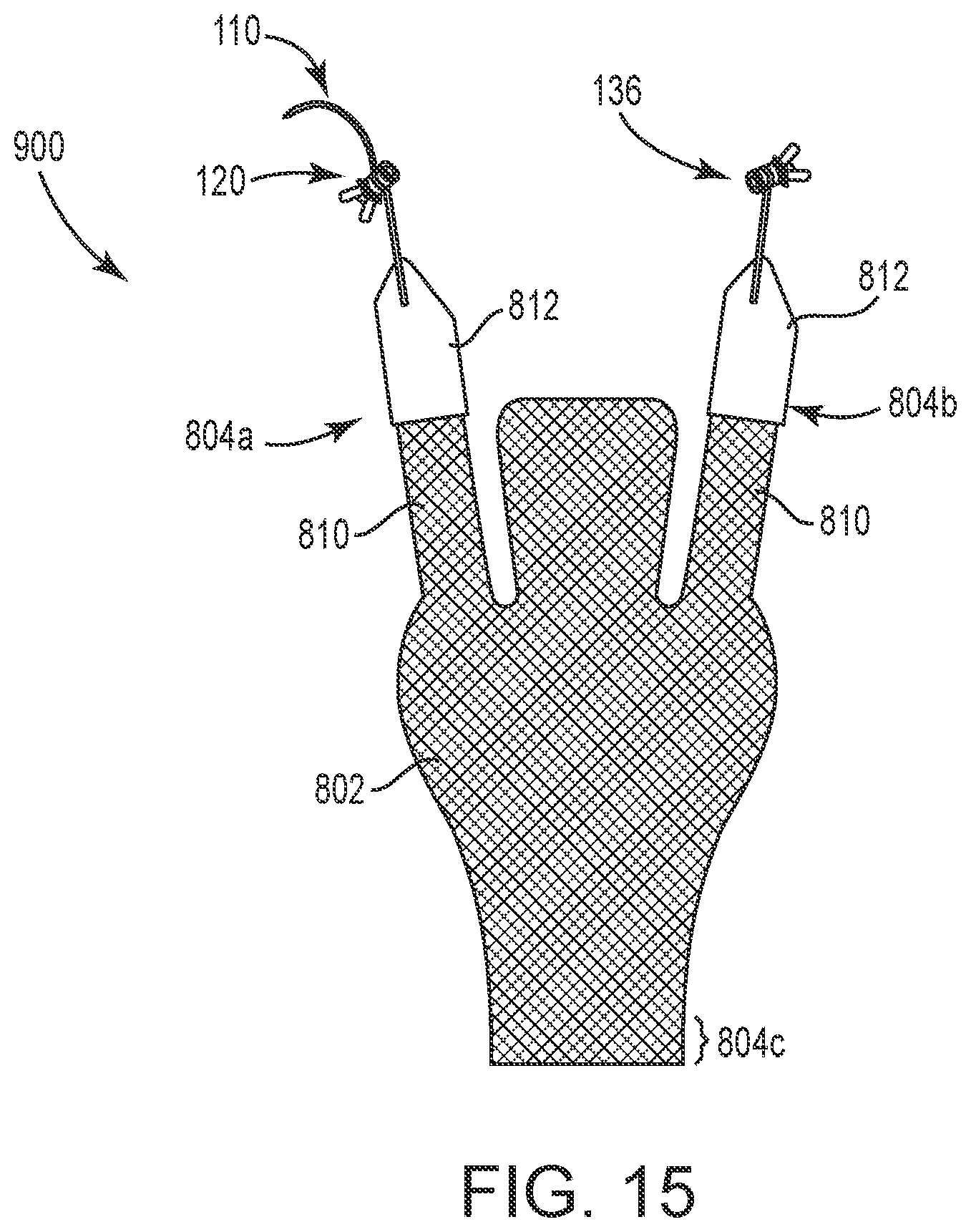 Patent US12551325 Figure 15 – Method of treating urinary incontinence in a patient by placing a sling in a single vaginal incision