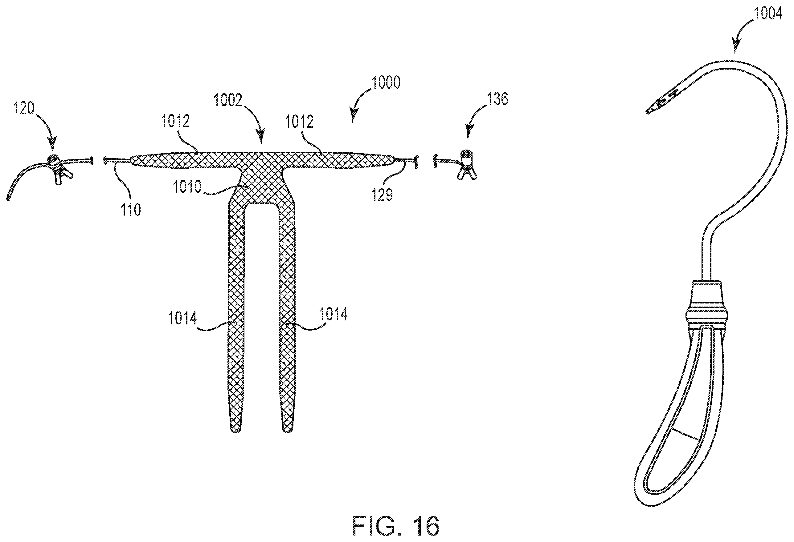 Patent US12551325 Figure 16 – Method of treating urinary incontinence in a patient by placing a sling in a single vaginal incision