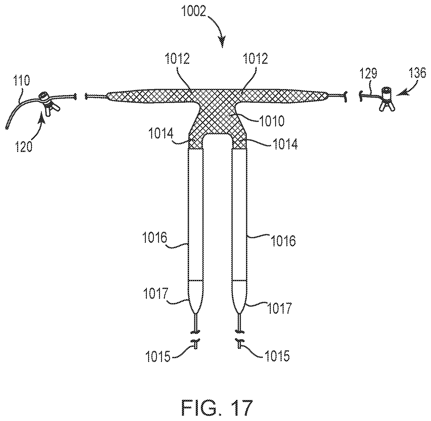Patent US12551325 Figure 17 – Method of treating urinary incontinence in a patient by placing a sling in a single vaginal incision