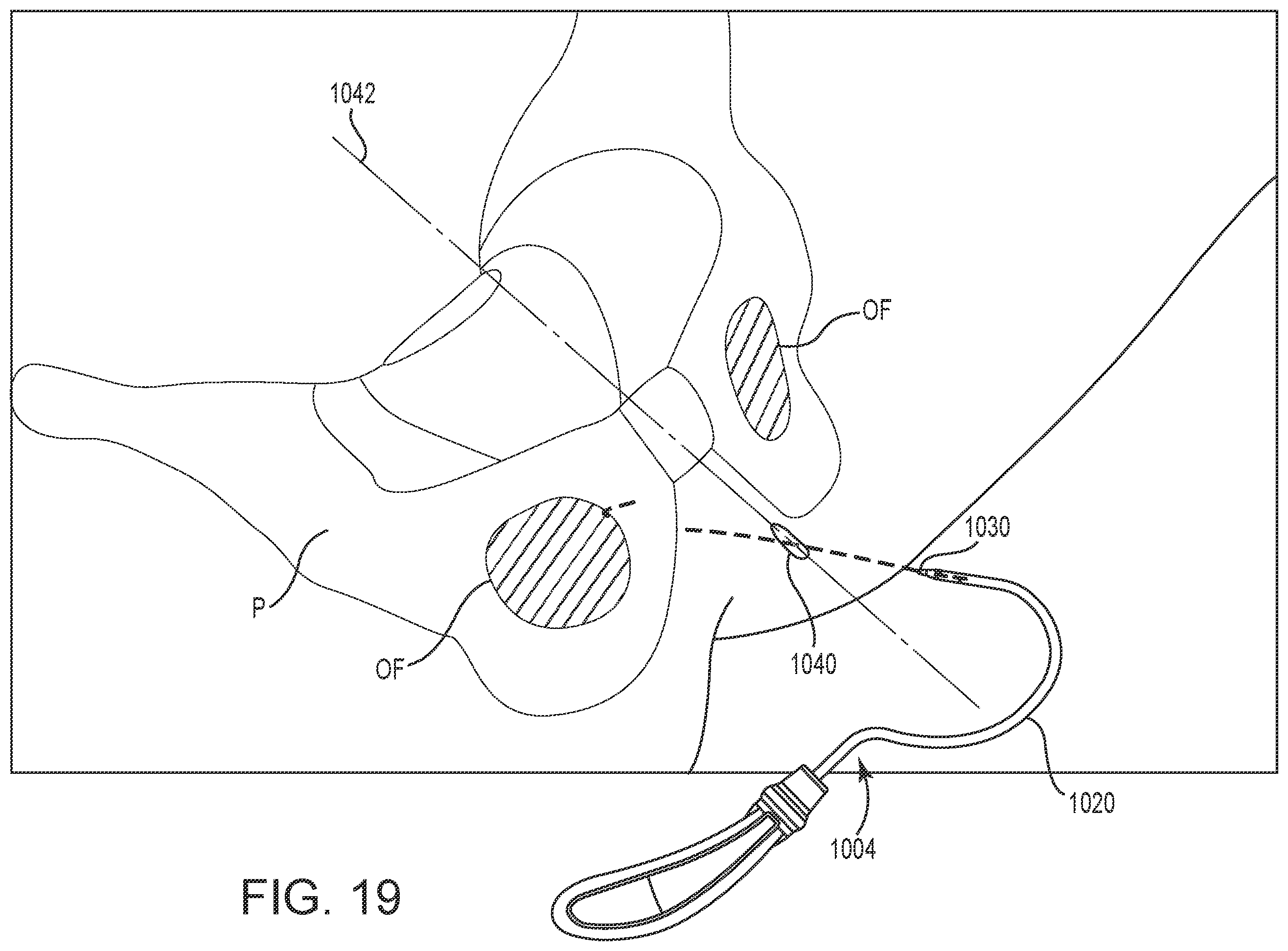 Patent US12551325 Figure 19 – Method of treating urinary incontinence in a patient by placing a sling in a single vaginal incision