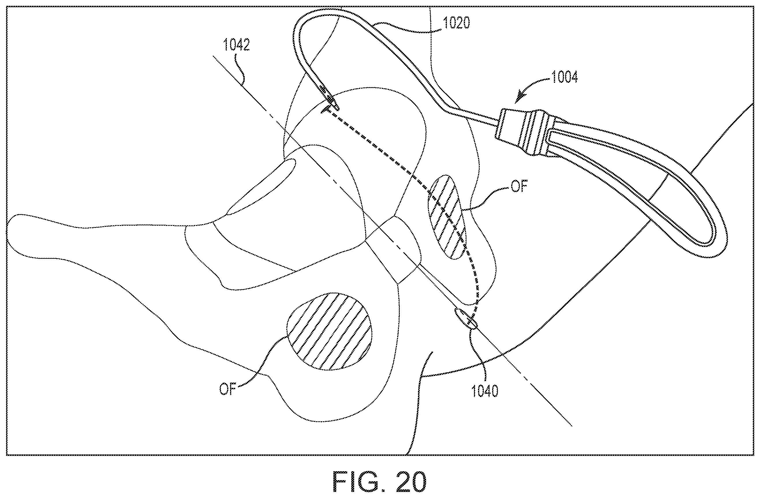 Patent US12551325 Figure 20 – Method of treating urinary incontinence in a patient by placing a sling in a single vaginal incision