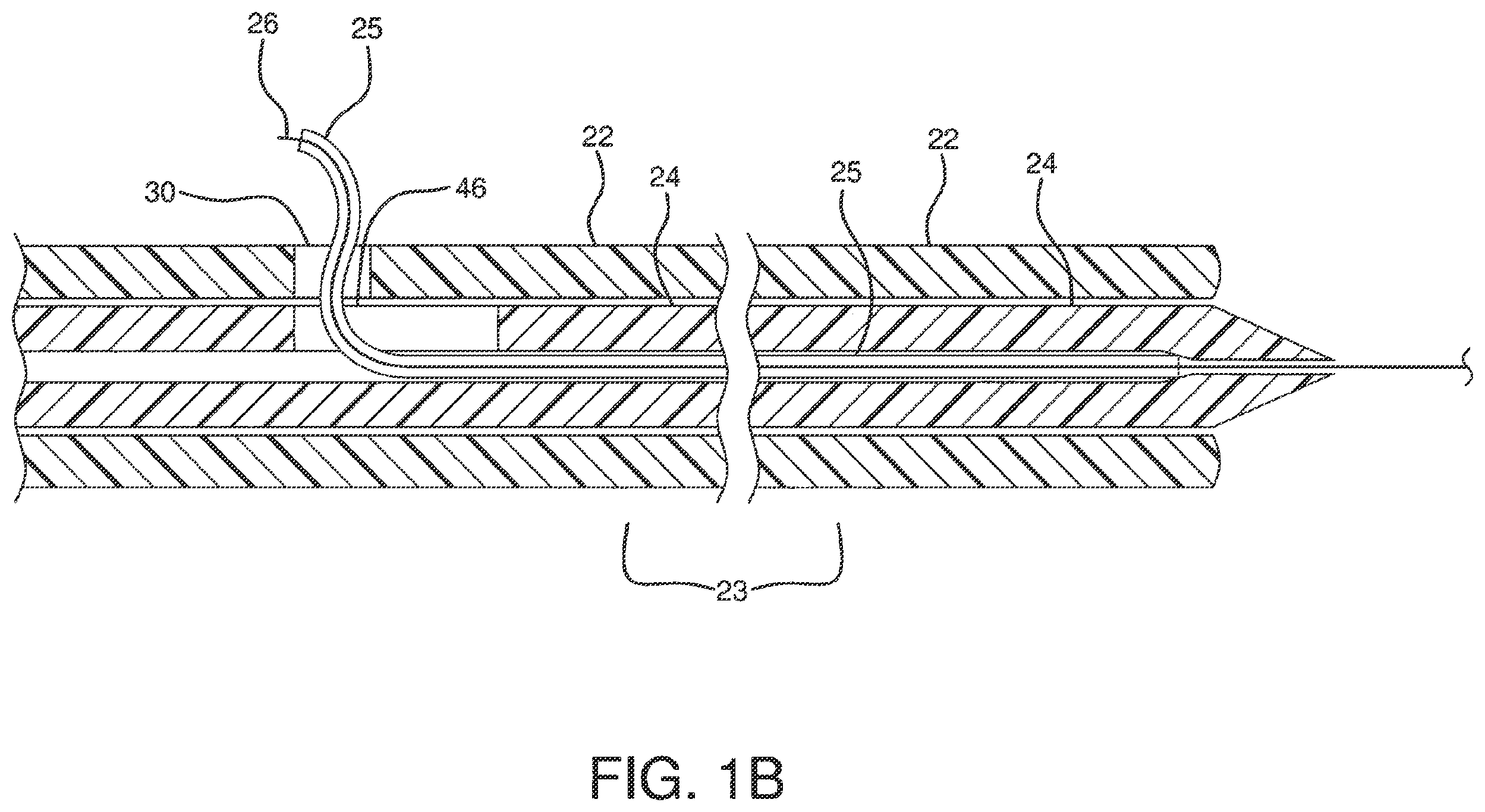 Patent US12551326 Figure 2 – Retrieval catheter