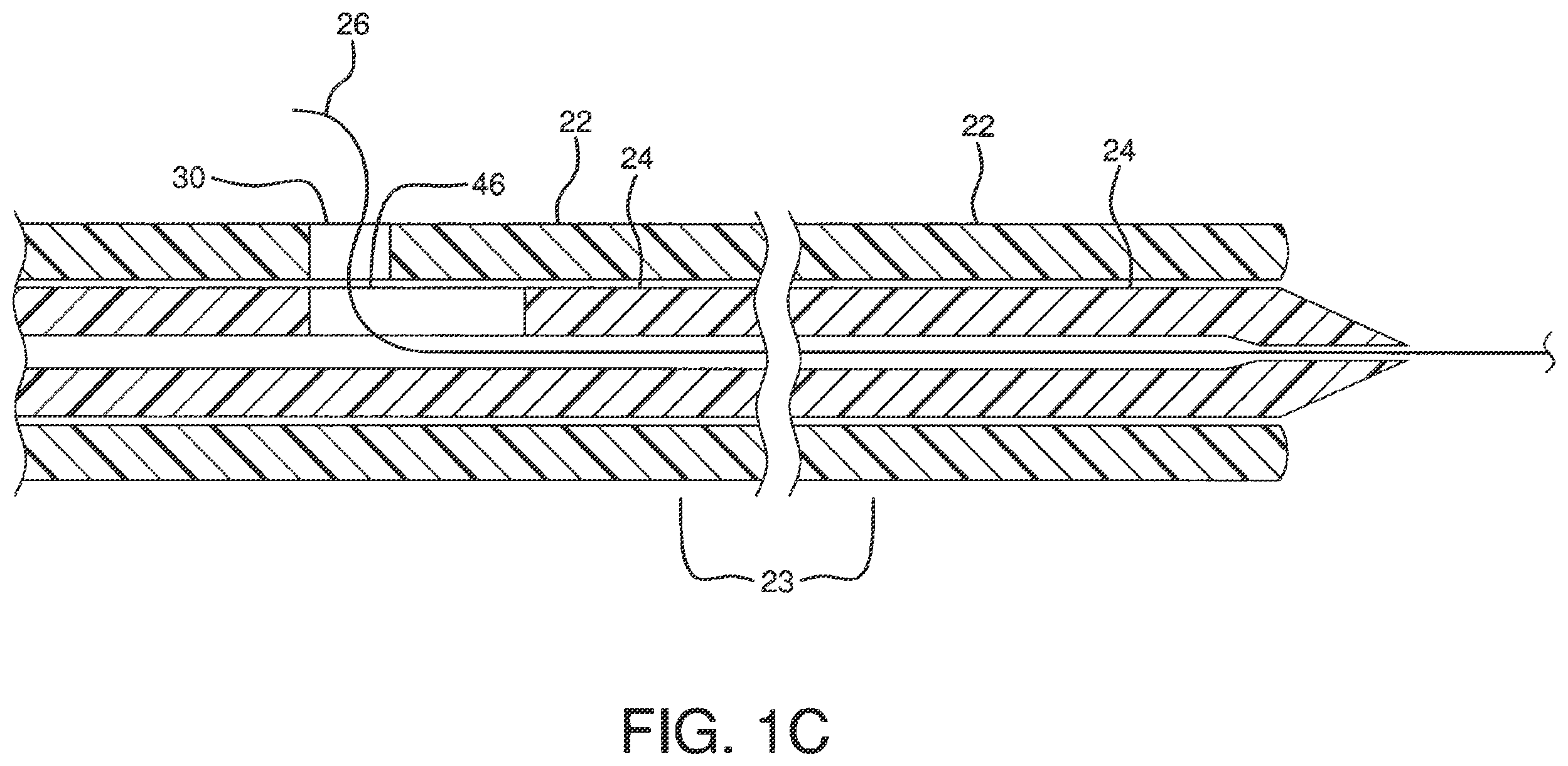 Patent US12551326 Figure 3 – Retrieval catheter