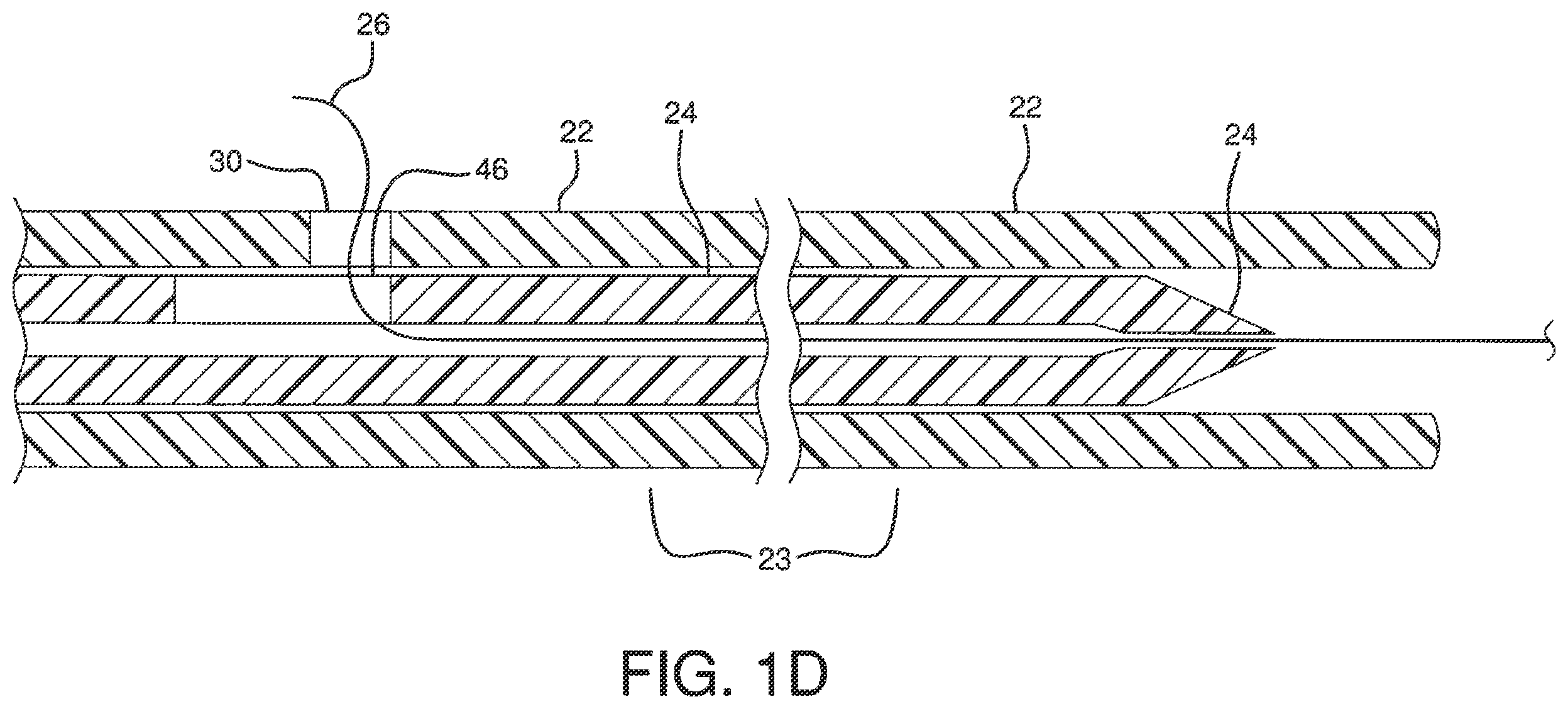 Patent US12551326 Figure 4 – Retrieval catheter