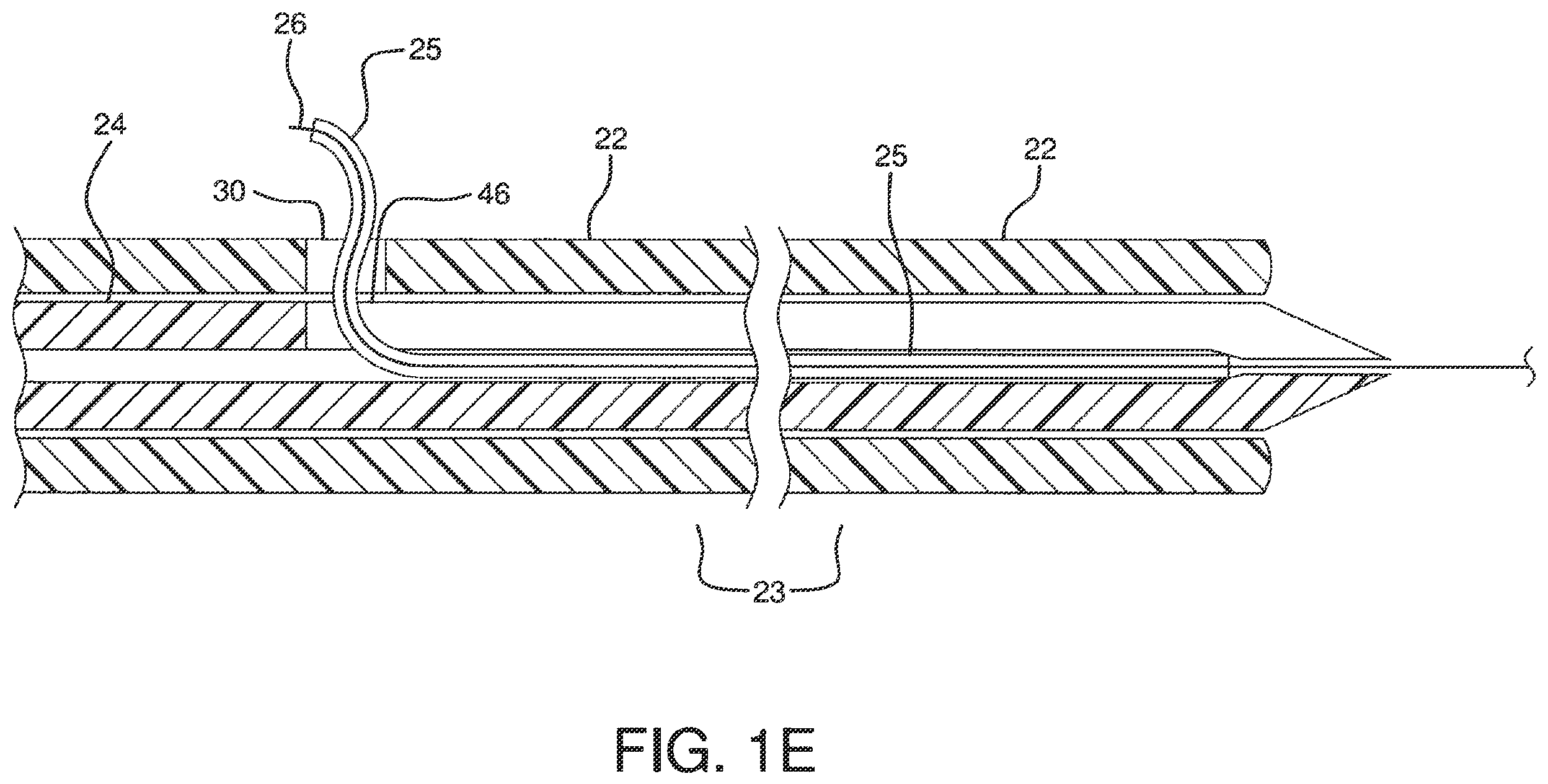 Patent US12551326 Figure 5 – Retrieval catheter