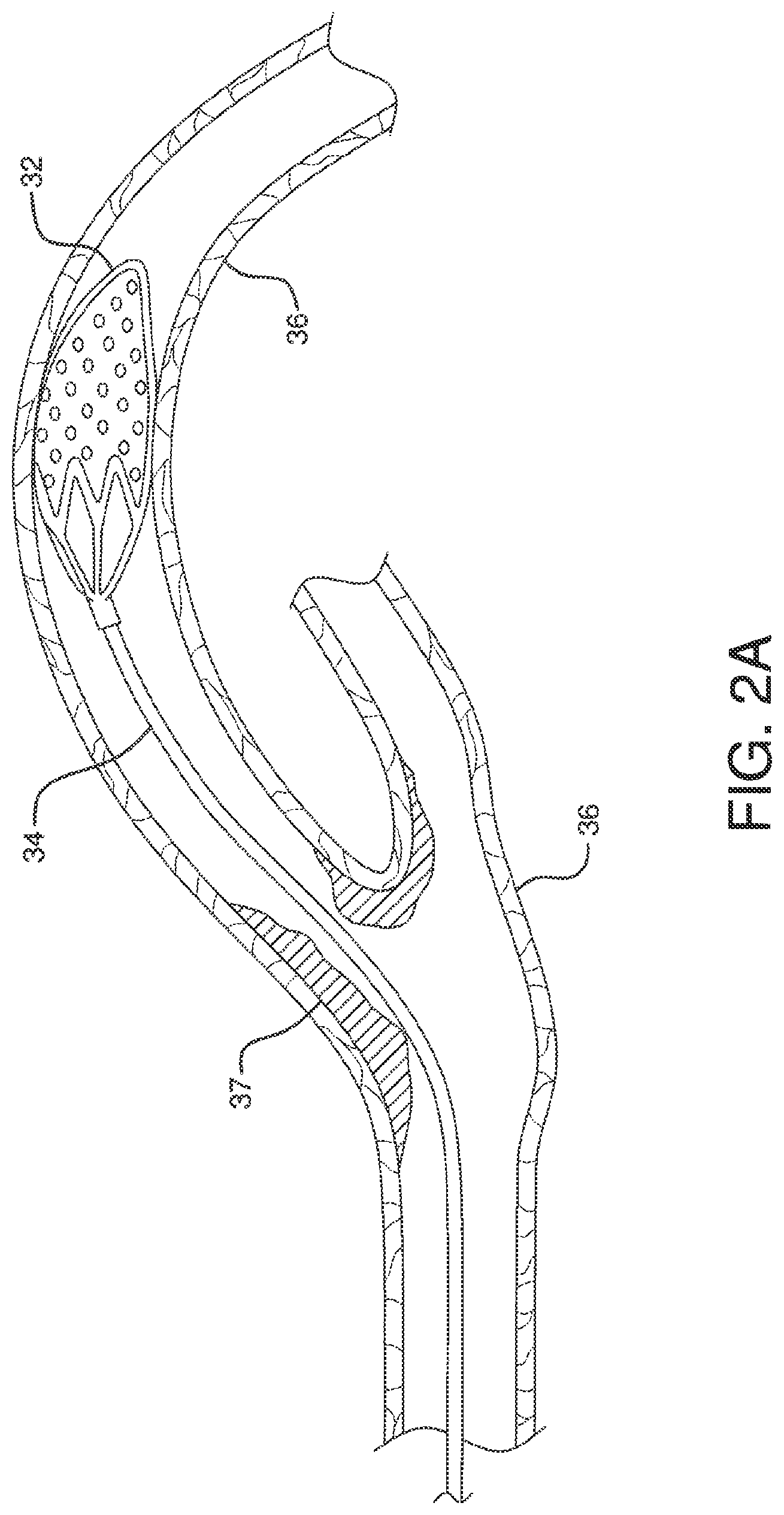 Patent US12551326 Figure 6 – Retrieval catheter